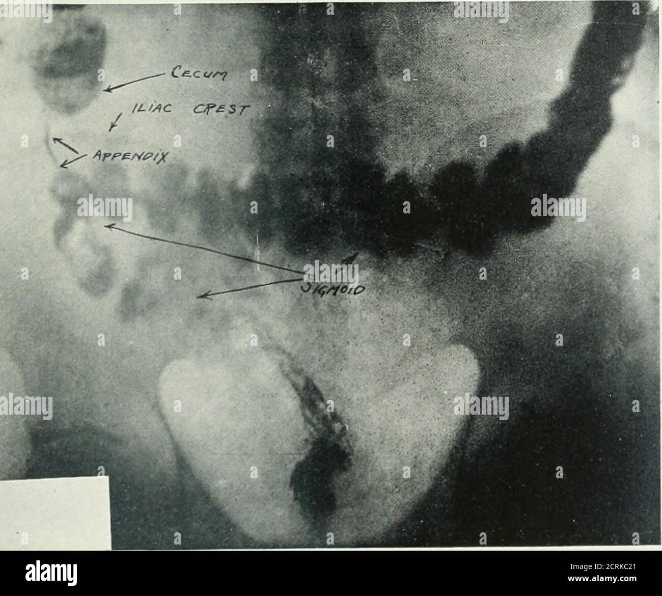 . Archivi di medicina fisica e riabilitazione . Maiale. 12 ampia fienura epatica, posizione relativamente hifh. Maiale-. 13. Colon pelvico, situato vicino al livello di cre»t di ileo. Mlifht essere »urmlsed essere il colon trasversale. Cecum e appendice visti sopra la cresta lilla. POSITIONAI- ANOMALIE DEL TRATTO IXTESTIXAL-HUBENY Foto Stock