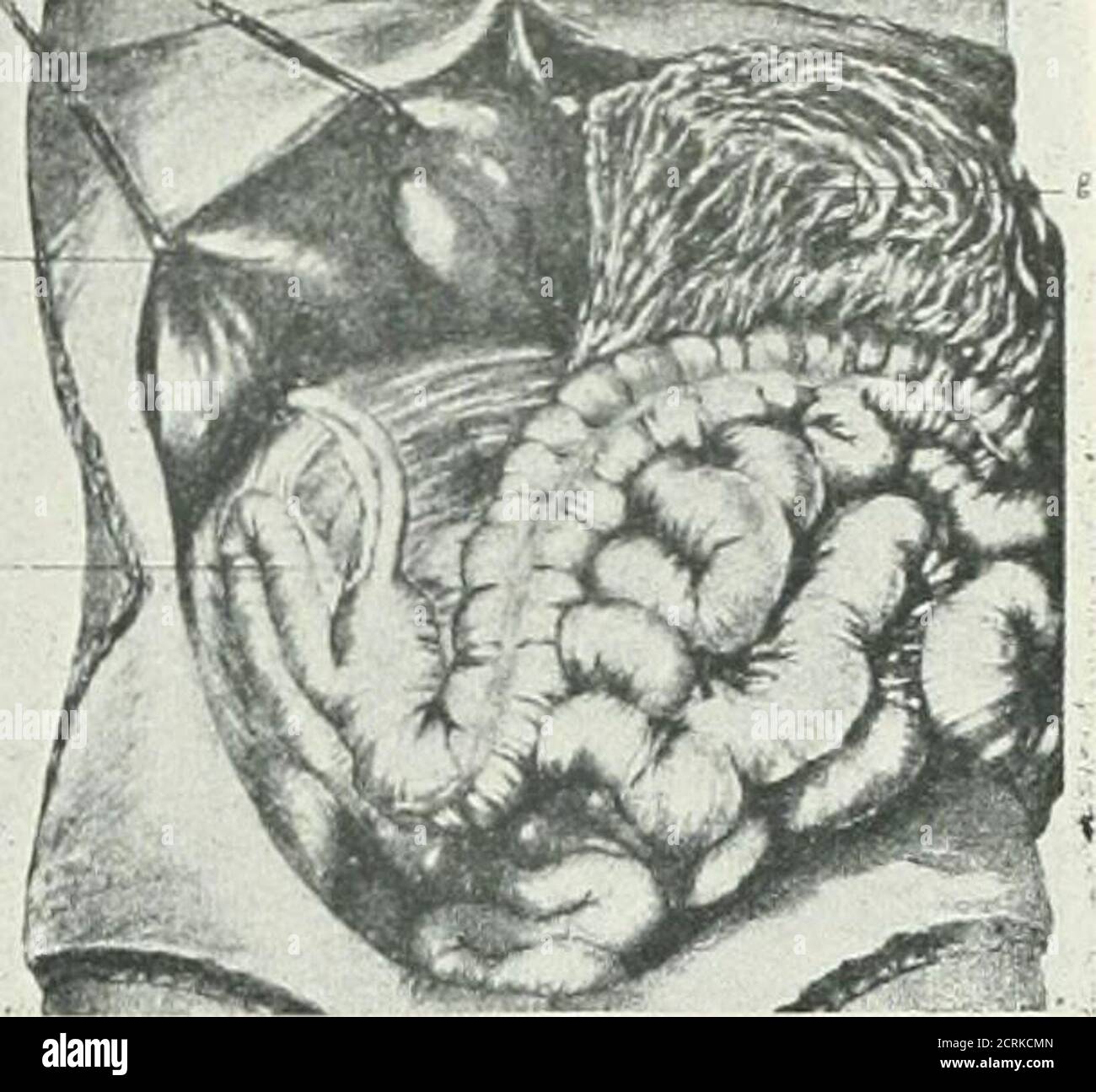 . Archivi di medicina fisica e riabilitazione . Tig. 4 – arresto rotazione intes-tine: (1.) fegato, (d.) duodeno, <s.i.)intestino tenue, (sp.) milza, (s.)stomaco, (s.f.) flexure splenix, (t.c.)seg-nient corrispondente al transversepolon, (a.c.) colon ascendente, (j.)giunzione ileocolica, (a.) appendice Huntington.). 6 – arresto rotazione intes-tine: (1) fegato, (i.) ileo terminale,(go.) grande omentum. (PROM Hunt-ington.) Foto Stock