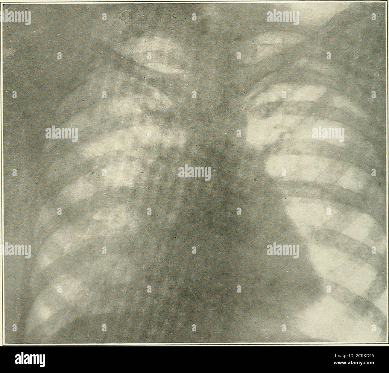 . Interpretazione Roentgen; un manuale per studenti e professionisti. Ent del cuore a sinistra. La polmonite lobare è caratterizzata da aree di maggiore densità uniforme che sono definite in modo netto e, una volta sviluppate in modo fulcrato, occupano di solito la posizione di un lobo. Negli stadi dell'orecchio l'ombra, sebbene uniforme, è meno densa e può essere di forma triangularina con la base sulla pleura e l'apice verso l'hilus. Le marcature polmonari distribuite in questa zona sono addensate e le 140 ghiandole dell'hilus DEL TORACE sono ingrandite. È stato osservato nei bambini thatdulhess e ha cambiato il respiro e. Foto Stock