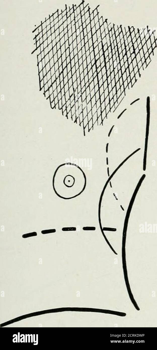 . I raggi Roentgen in medicina e chirurgia come ausilio nella diagnosi e come agente terapeutico; destinati all'uso di medici e studenti. Contrazione del polmone, il cui risultato sarebbe quello di attirare il cuore verso il formerorgano; oppure può derivare dalla maggiore escursione del diaframma su un lato rispetto all'altro; per se c'è una differenza marcata nello spostamento del diaframma nei due lati del petto, l'effetto wouldbe di spingere il cuore più lontano verso il lato malato che wouldnaturally va fatto entrambi i lati del diaframma si muovono normalmente. Più tardi inthia malattia Foto Stock