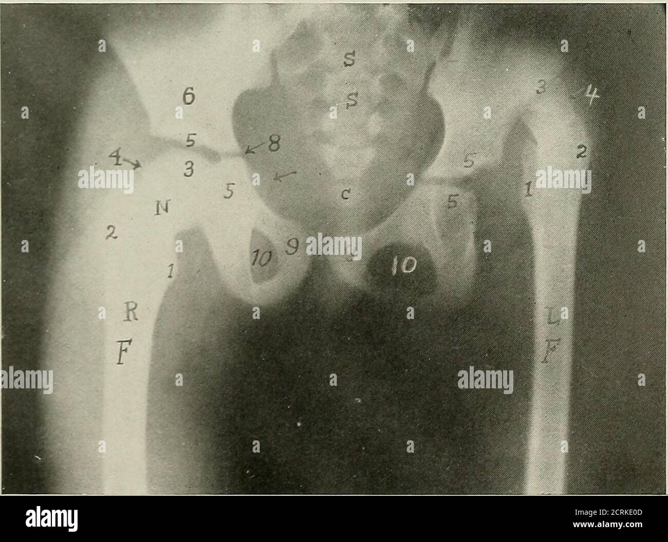 . Röntgen raggi ed elettroterapeutici : con capitoli su radioterapia e fototerapia . Fig. 1-16.-frattura intertrocanterica incompleta. (Caso del Dr. W. L. Rodman.. Fig. 147.-disposizione CoxGENTTAL OP TESTA del femore SINISTRO.-1, trocantere minore: Trocantere maggiore; 3, testa; 4, collo; 5, acetabolo. (Caso del Dr. H. Augustus Wilson) Foto Stock