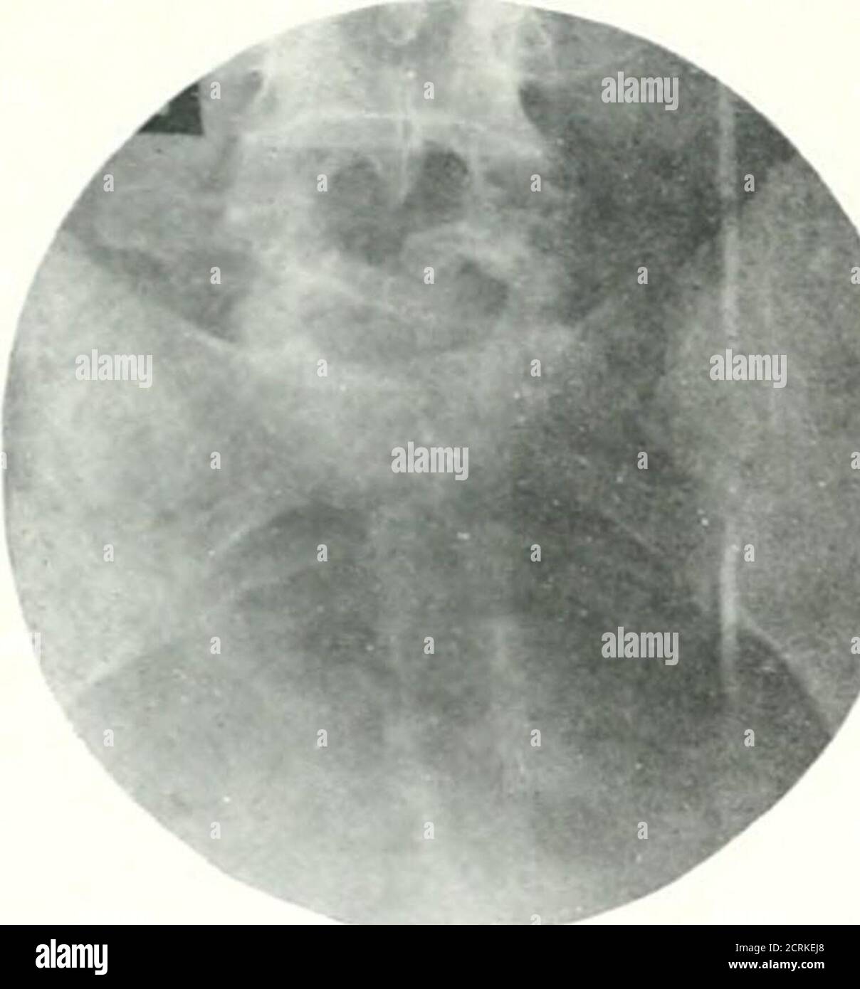 . Archivi di medicina fisica e riabilitazione . Fig. 14 (A268500). Difetto congenito nella terza e quarta vertebra toracica con segni o sintomi. Maiale. 15 (A316979). Spina bifida nella vertebra toracica. Maiale. 16 (A240447). Segni e sintomi bifidaparententi di spina. 359 ANOMALIE DELLO SVILUPPO DELLA SPLNE-SUTHERLAND. Fig-. 17 (A293929). Segni e sintomi di spina bifida pre-Bentin^r. L'età è significativa. I disturbi del controllo dello sphincter sono comuni, come paralisi areomotoria e disturbi sensoriali, che in nessun caso si verificano in modo indipendente. L'incontinenza a volte si sviluppa più tardi nella vita. Foto Stock