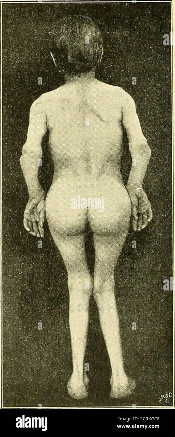 . Klinische und Anatomische Untersuchungen über den Cretinismus . Nasenlänge 3,6, Breite 4,0; Distanz Nase-Kinn 5,4, Entfernung der äusseren Augen-winkel 9,8, der inneren 3,6. OHR: Längster Durchmesser 5,95, grösste Breite 2,65, wahre Länge 3,1, Ohrbasis 4,5. Entfernung Jugulum - Symphyse 40,0, Jugulum - Proc. Xifoide. 16,0, Proc. Xifoide.-NABEL 13,5, Trochanterendisanz 25,0, DiameterBaudeloquii 13,5. Halsweite 31,0, Bauchumfang 57,5. Oberarm 22,0, olecranon-Mittelfingerspitze 33,0, Oberschenkel 28,0 cm. Körpergewicht 32,8 kg. Vom 17. Maggio 8. Giugno 1901 langsam ansteigend 1-3 Schilddrüsentablett Foto Stock