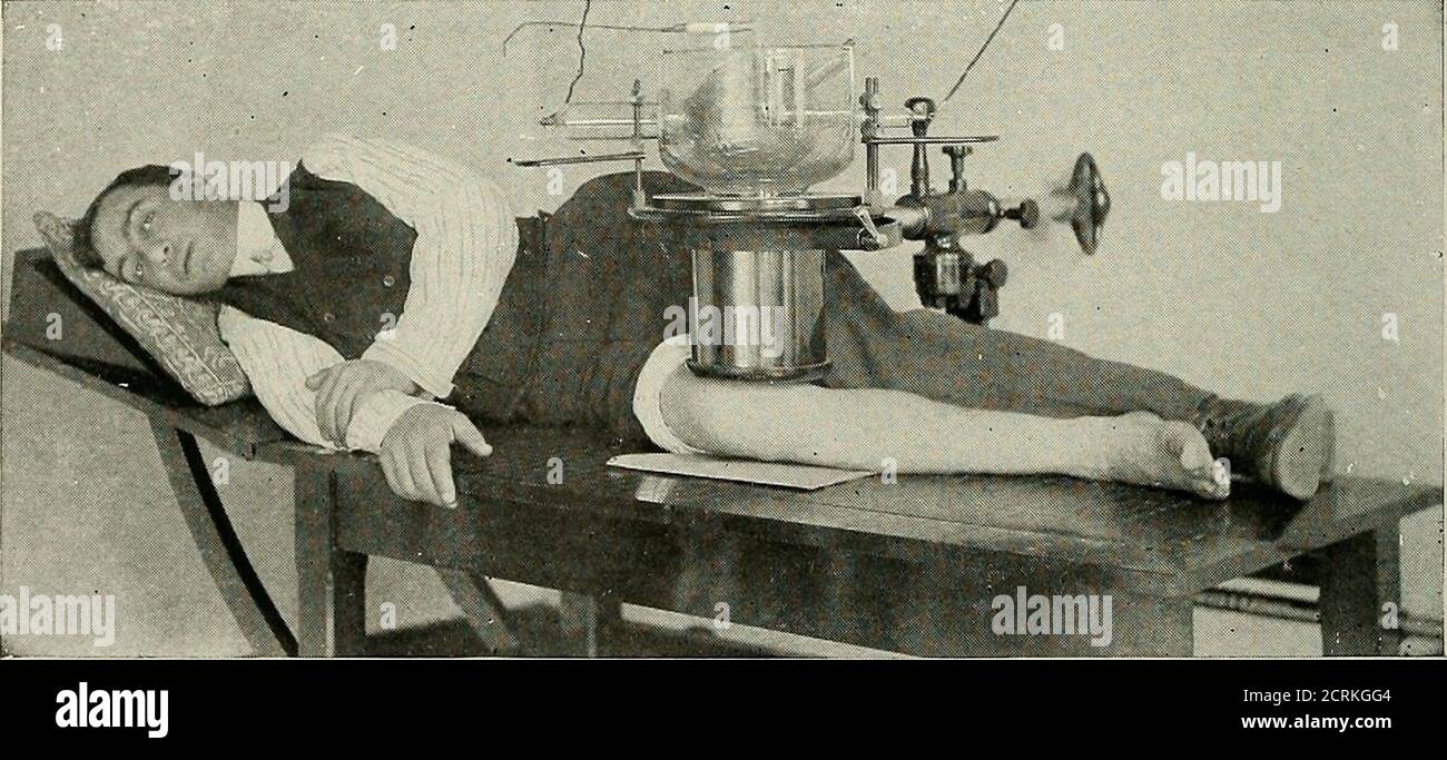 . Röntgen raggi ed elettroterapeutici : con capitoli su radioterapia e fototerapia . Fig. 139C.-articolazione della caviglia (vista antero-posteriore).-UNA foglia del tavolo viene sollevata e viene piazzata una tavola per coprire l'apertura, e per entrambe le caviglie una piastra da 10" x 12". (25 x 30 cm.); i diaframmi fissati sulla linea mediana; per confronto entrambi i piedi sono legati alla foglia verticale. Quando una caviglia deve essere radiografata, portare il diaframma di compressione vicino a quel giunto. Tarso, metatarso e falange (vista dorsale). Questi possono essere radiografati posizionando la platein una posizione verticale contro il pl Foto Stock