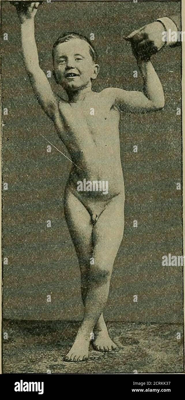 . Un trattato pratico sulla diagnosi medica per studenti e medici . Vista laterale di un caso di paralisi agitans, mostra l'inclinazione in avanti del tronco. Tendenza alla propulsione. (Dercum.) Paraplegia spastica, progressione a gambe incrociate.(Dercum.) Nella sclerosi insulare disseminata, l'andatura è alquanto irregolare e resemes-bles l'andatura dell'atassia o del tumore del cervelletto. Naturalmente, la disinvoltura che causa tale peculiarità nella deambulazione non può essere stabilita senza osservare in prima persona i fenomeni mentali e nervosi che assistono a tali affezioni. Nella paraplegia isterica vi è talvolta una perdita completa di po Foto Stock