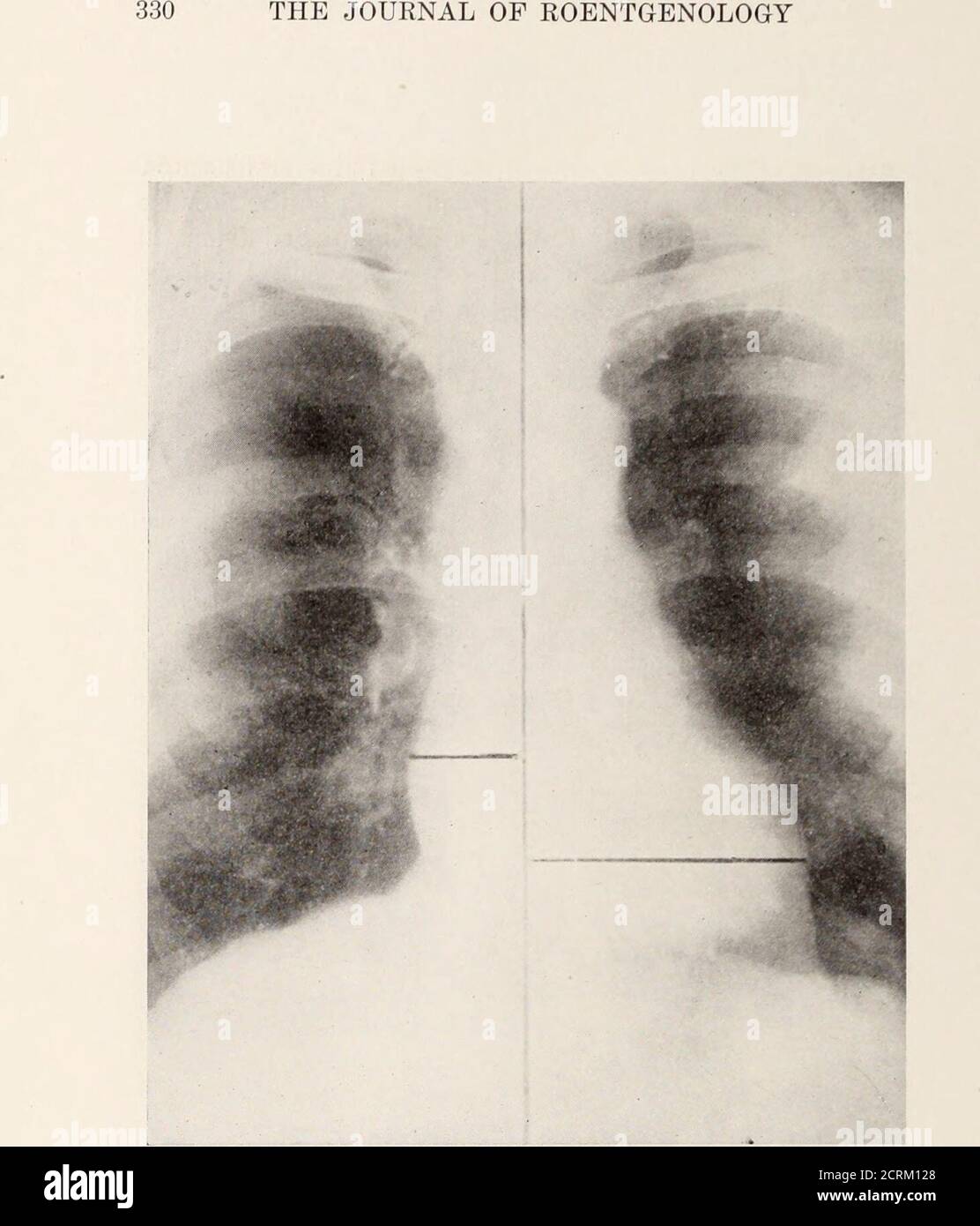 Versamento pericardico immagini e fotografie stock ad alta risoluzione