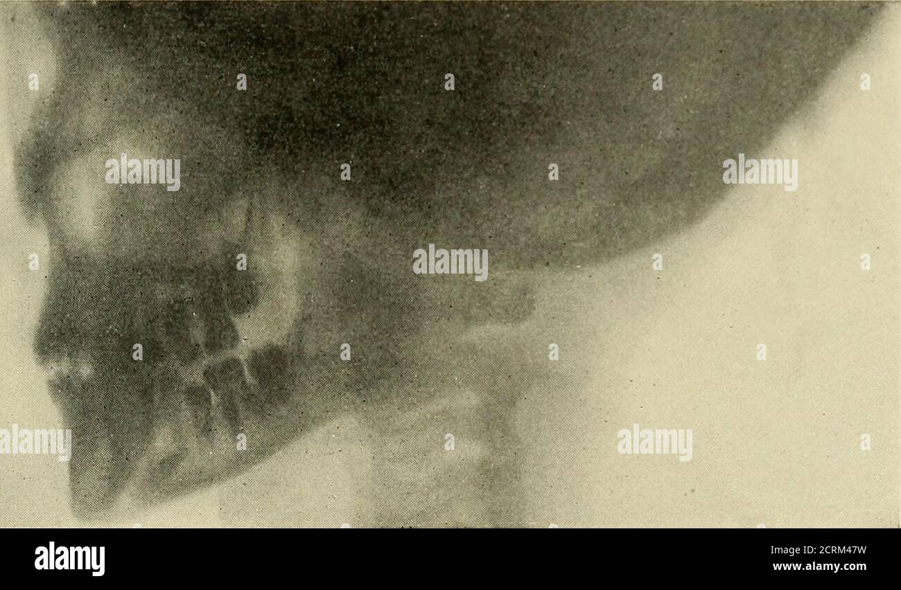 . Diagnosi e terapia dei raggi Röntgen . Fig. 47.-incisore, situato trasversalmente nella mascella superiore di aGirl di quindici anni. Sono richiesti, film flessibili possono essere introdotti nella cav-ity orale, dove si adattano ai contorni della max-illa. A tale scopo devono essere utilizzati supporti speciali in metallo. LA TESTA 77 tali supporti possono essere collocati sui denti, il paziente potendo chiudere la bocca. Le cartucce di pellicola H-inch, generalmente utilizzate per la Browniecamera, possono essere utilizzate per esposizioni brevi. In particolare gli incisivi anteriore superiore e inferiore, i canini superiore e inferiore della tessere, t Foto Stock