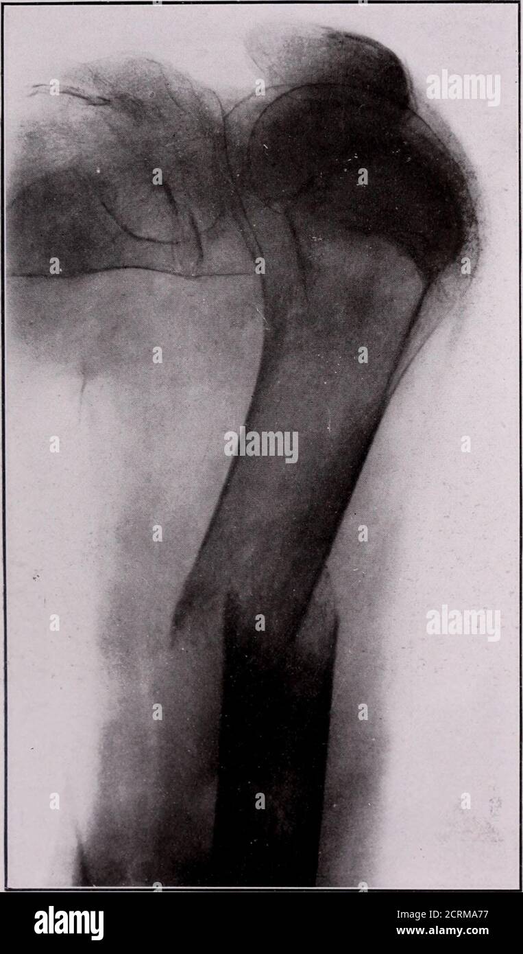 . Giornale di radiologia . Fig. 7 agosto 23, 1919. Metastasi al cranio. Xote il nuovo deposito osseo inrays perpendicolare alla superficie del cranio, caratteristica di osteosarcoma. Alsonote le zone di rarefazione ossea in altre pr.rts del cranio. OSTEOSARCOMA - KNERR 85. Fig. S 27 febbraio 1920. Frattura patologica spontanea del femore nel sito di una nuova area di coinvolgimento. Confrontare la fig. 0 per il sottotrattamento rapido della formazione dei caloni. THE JOURNAL OF RADIOLOGY Foto Stock