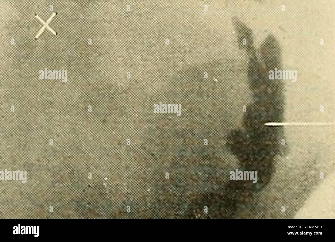 Ampolla rettale immagini e fotografie stock ad alta risoluzione Alamy