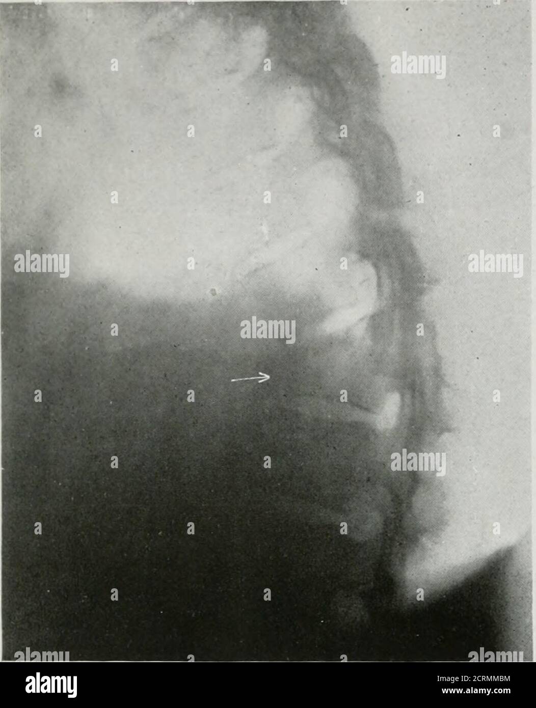 . La rivista americana di roentgoenologia, radioterapia e medicina nucleare . Fig. Vista laterale della Figura 2.Nessuna paralisi. Recupero. Ma non come regola nel mezzo o sottile.UNA grande camera d'aria di gomma, l'interno della sfera di ahand, è usato per compressione pur-pose. È spesso posizionato sotto ilone, non per la compressione,ma come filtro supplementare. In machingla proiezione laterale aiuta a steadythe paziente. Preferisco piuttosto fare il lavoro spinale sul tavolo di aCole poichè con il relativo uso si può giudicare l'illuminazione che è gettingthrough e regolarla di conseguenza. Ho per SEV Foto Stock