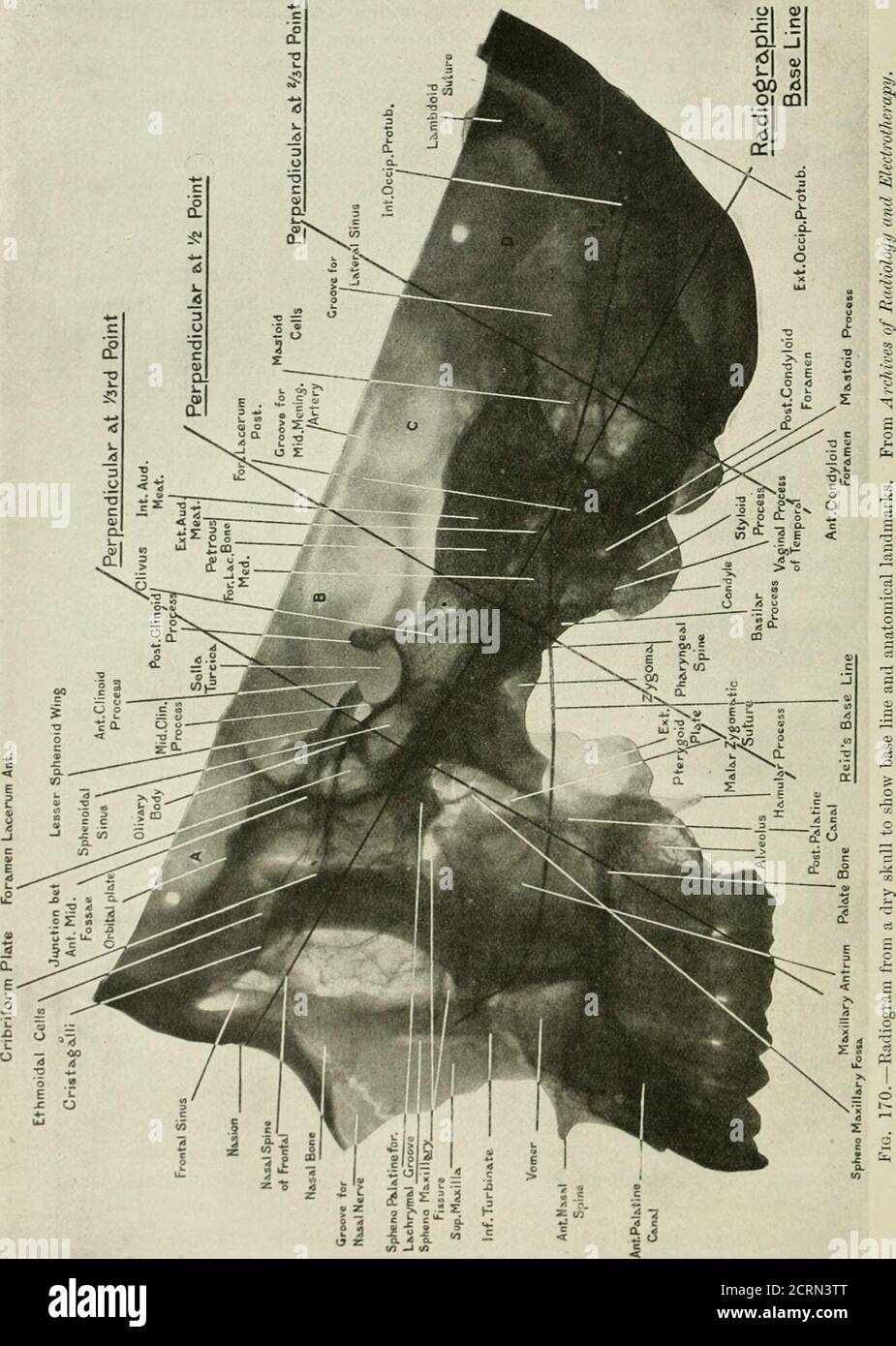 . Radiografia e radioterapeutica . sure di Rolando, e sotto la tonalità di base con il margine posteriore del ramus ascendente della mandibola inferiore. La perpendicolare alla distanza di due terzi bisetta la lobedel parietale del cervello. Queste tre linee dividono la testa in quattro zone che possono essere caleA, B, C, D, da prima all'indietro. La regione A contiene la fossa anteriore del cranio con la metà anteriore del lobo frontale, le orbite e le ossa facciali, ad eccezione dei rami ascendenti delle mascelle inferiori e delle ossa palate. La regione B contiene il corpo dello sfenoide e il maggiore Foto Stock