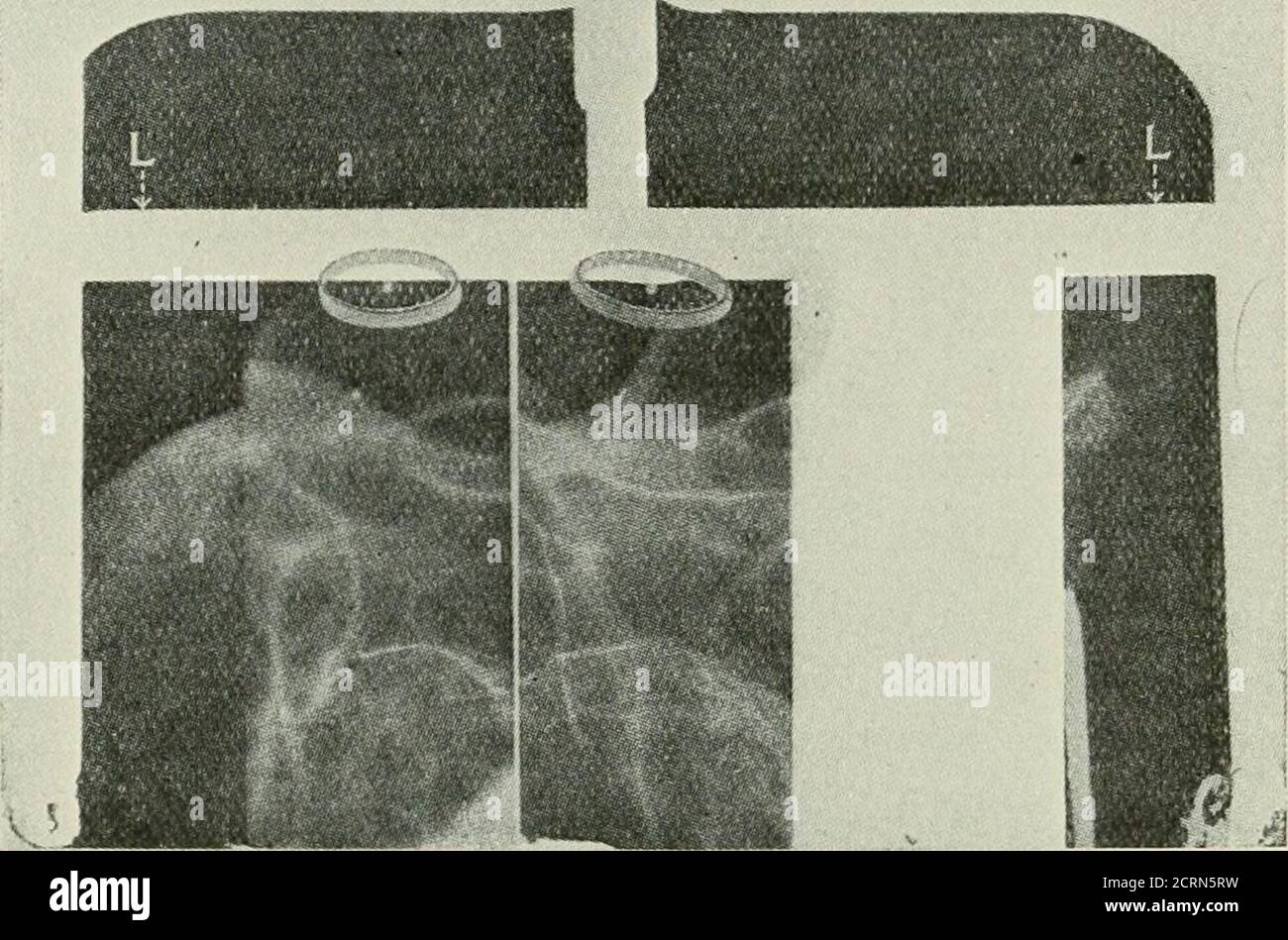 . Radiografia e radioterapeutica . M^: FK;. 155.-diagramma del sjsteni ottico.(Dr A. W. Salnioud.) Y, immagine verticale della palla come visto da occhio inleso ; M, specchio ; X, occhio ferito ; Y, occhio inleso. 184 RADIOGRAFIA il tubo, portando con sé l'indicatore e la piastra, viene spostato ad una distanza definita verso i piedi del paziente e la seconda esposizione in una sola volta sulla porzione precedentemente protetta della piastra. Fig. 156.-Facsimile riproduzione di doppio radiogramma dell'occhio, showingposition della palla indicatrice in relazione al corpo estraneo in due piani. È clamidato che la protezione efficiente t Foto Stock