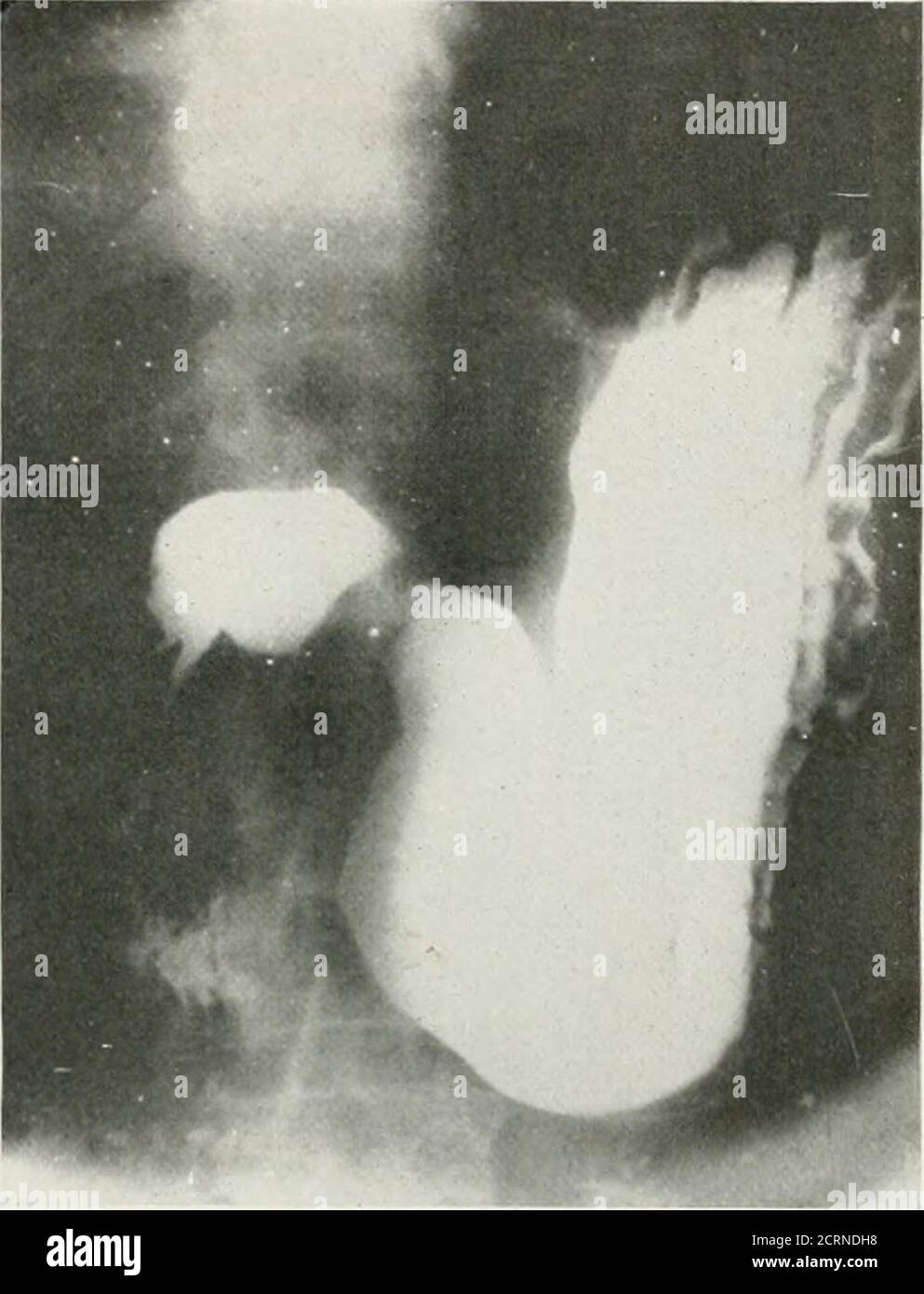. La rivista americana di roentgoenologia, radioterapia e medicina nucleare. Deformityis noted on the lessercurvature. Si osserva un difetto di irregolarità che sul palpazionepuò essere aumentato o diminuito e non si muove sulla respirazione; allo stesso tempo sono presenti terugae dello stomaco. Spleeii. I tumori della milza sono facilmente riconoscibili dal teygive deformabile nello stomaco pieno di bario e dalla deformità della flessione splenica con l'enema del bario. L'organo ingrossato con il suo contorno liscio e uniforme può essere sedespostando lo stomaco verso destra con la pressione più grande vicino al fundo,g Foto Stock