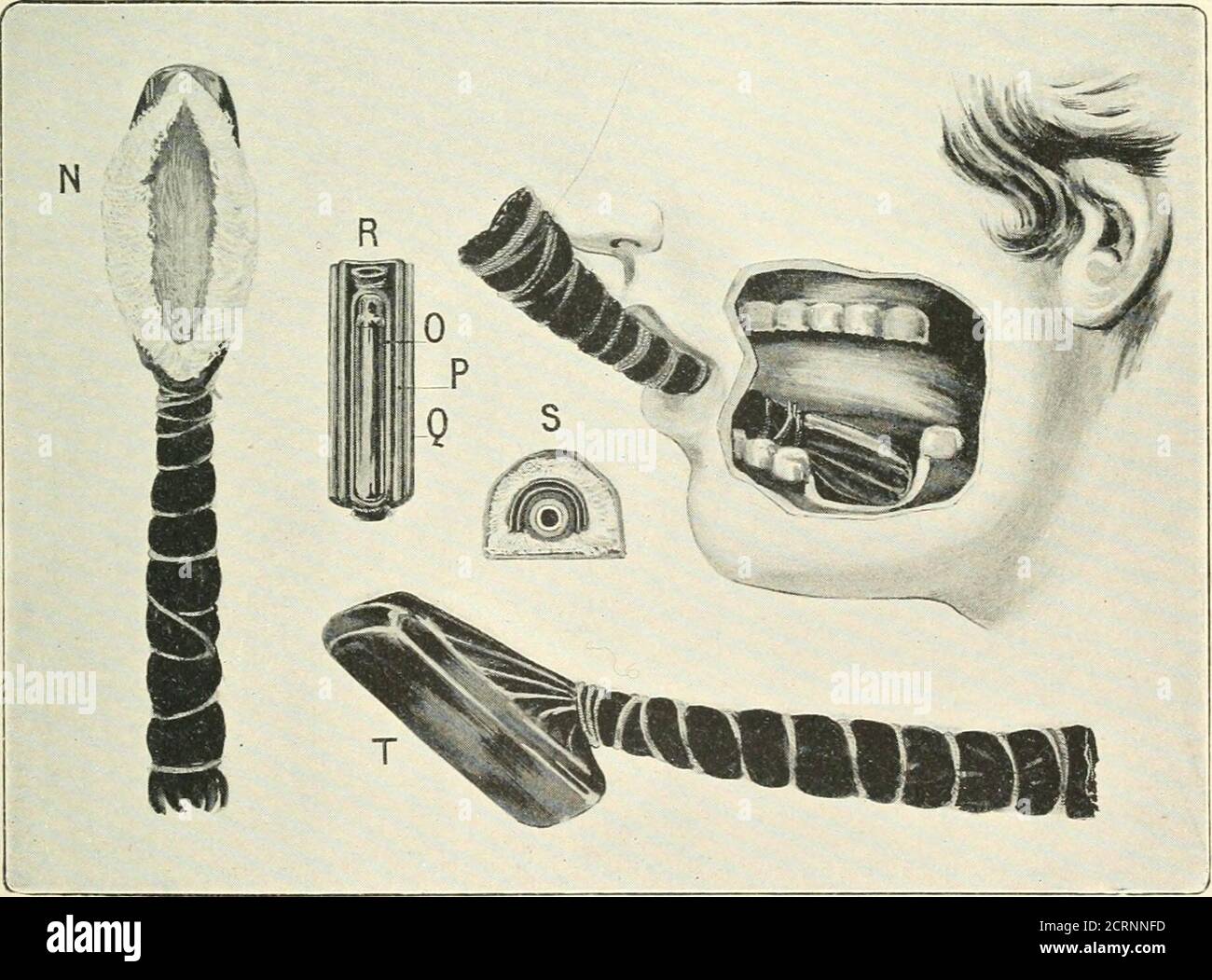 . Radiografia, terapie radiologiche e radioterapia . utilizzo o per altri motivi non adatti al funzionamento, il radium è un rimedio utile. Casi inoperabili radium può aiutare a rendere il caso operabile, e il fallimento che è indubbiamente utile come misura palliativa. Quando un tumore di grandi dimensioni di tipo inoperabile deve essere trattato, è utile combinare i raggi X con il raggio. Il primo può essere usato per irradiare l'area tumorale e i linfatici che la drenano, e dopo un tempo, quando il tumore si è posato, i tubi radiosi possono essere introdotti nel thesubstance della crescita e lasciati in sit Foto Stock