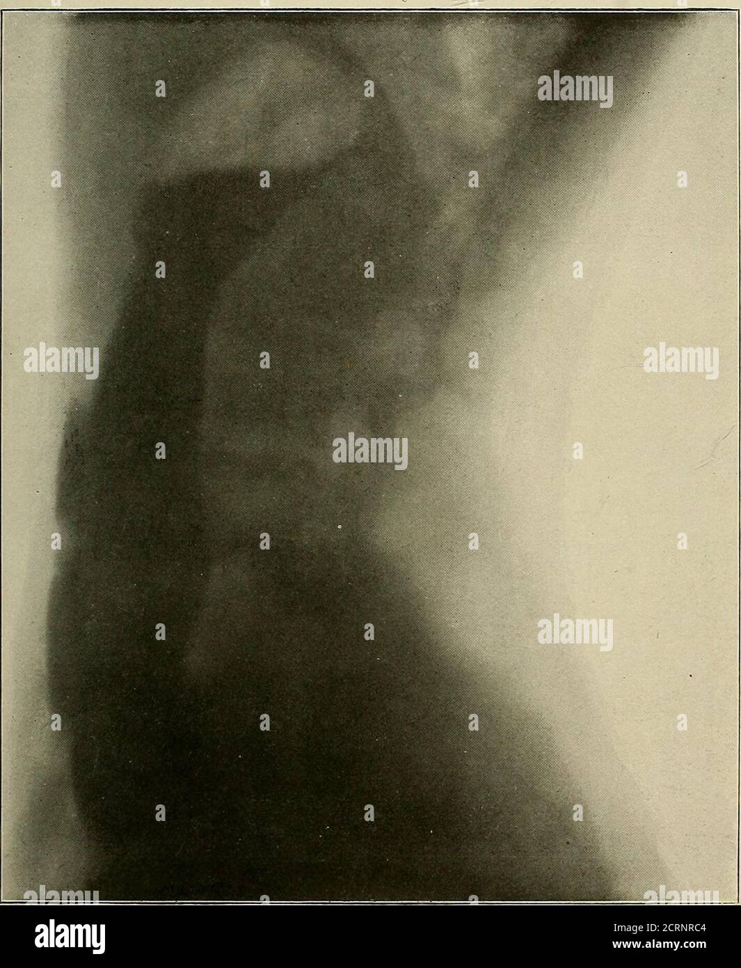 . Un testo-libro di radiologia . GASTROPTOSIS. Vedere pa.geil73. PROPRIETÀ OFVICTOR X-RAY CORPOR PLATE XI.. Una vista laterale dello stesso caso della piastra X. mostra come lo stomaco viene posto nella cavità addominale nelle sue relazioni antero-posteriori. PIASTRA XII. Foto Stock