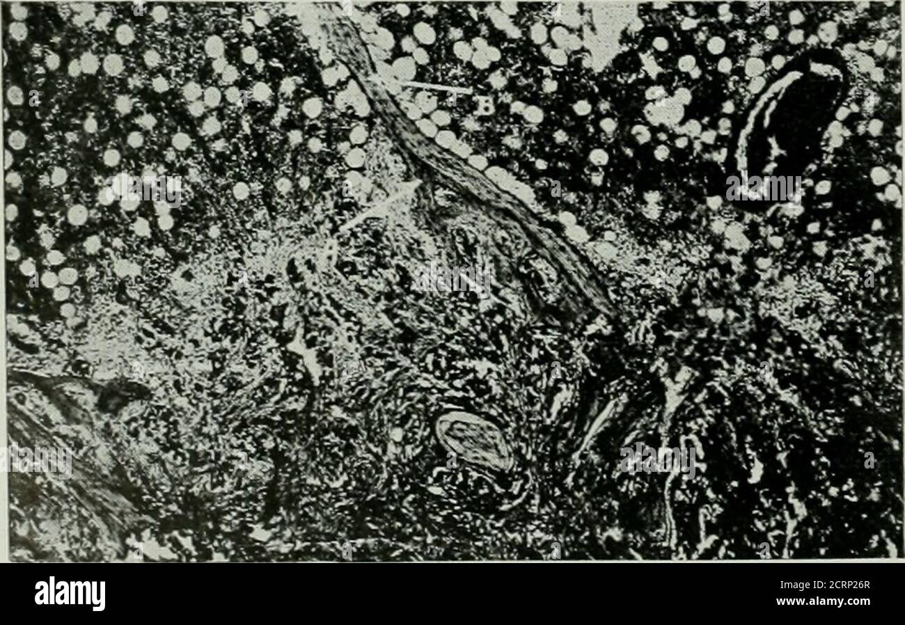 . La rivista americana di roentgoenologia, radioterapia e medicina nucleare . Fig. 7. Microfotografia. Minuto No-modulo DI carcinoma nel midollo osseo, a mostra carcinoma; b normalmidollare.i patologi (Borst,^ Schmidt, Orth) de-scrivono lo stesso fenomeno che si verifica spontaneamente nell'uomo. Uno stroma del tessuto connettiveTissue circonda un gruppo di cellule cancerose, aumenta gradualmente di dimensione, comprime. Fig. 8. Microfotografia. Mostra una grande quantità di formazione di nuovo osso nelle vicinanze di un OldBridge di tessuto osseo compatto, b mostra oldbone; un nuovo osso. Le cellule tumorali e produce una cura locale del crescito Foto Stock