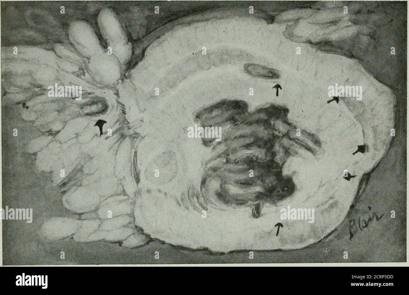 . La rivista americana di roentgoenologia, radioterapia e medicina nucleare . Fig. 28. Stesso caso della Figura 27, quattro Lur^ più tardi, che mostra completa ostruzione al enema del bario. L'operazione ha rivelato massa infiammatoria cronica. L'aspetto non è diverso da una cronicperforazione di ulcera gastrica o duodenale. La piastra può presentare una cavità ascessa riempita con conbario all'esterno del lume dell'intestino, con istmo asmale di bario che lo collega con l'intestino. Le perforazioni acute non cometo l'uomo .^--raggio. Alcuni degli attaccaceti di diverticolite acute simulano un'appendice a sinistra. Il bariumenema può essere di lui Foto Stock