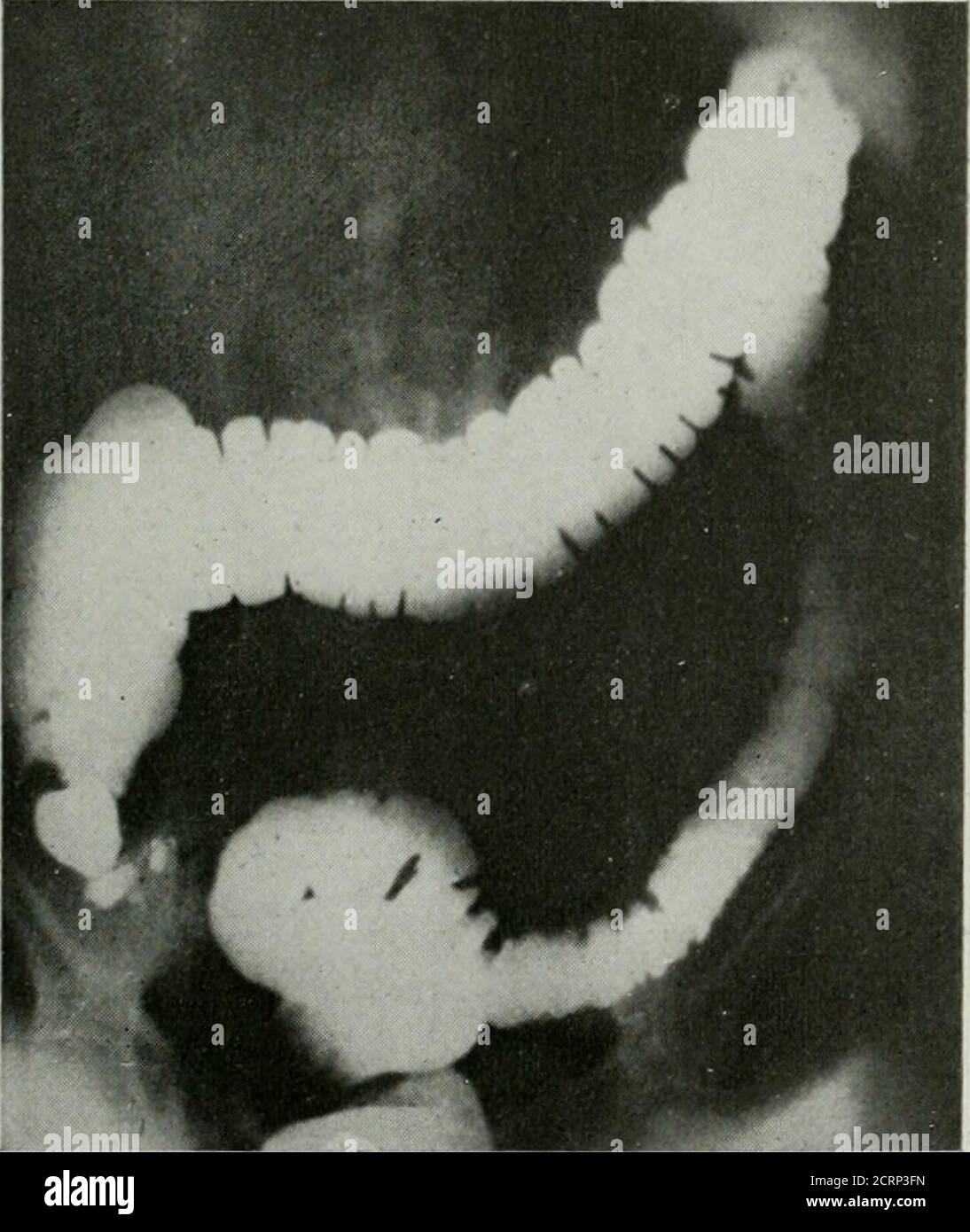 . La rivista americana di roentgoenologia, radioterapia e medicina nucleare . Fig. 23. Alterazioni infiammatorie croniche Colon discendente e sigmoide involvente. Non si vedono diverti-cula, ma l'intestino presenta un aspetto dentato come si trova associato con Diver-ticuHtis. Classe III. La condizione che è importante per differenziare dai casi di questo gruppo e del terzo gruppo è il carcinoma. Non credo che una differenziazione positiva possa essere sempre Fig. 24. Le alterazioni infiammatorie croniche aboutthe Colon discendente e sigmoide. Takenadopo un enema di bario. L'aspetto seghettato è Foto Stock