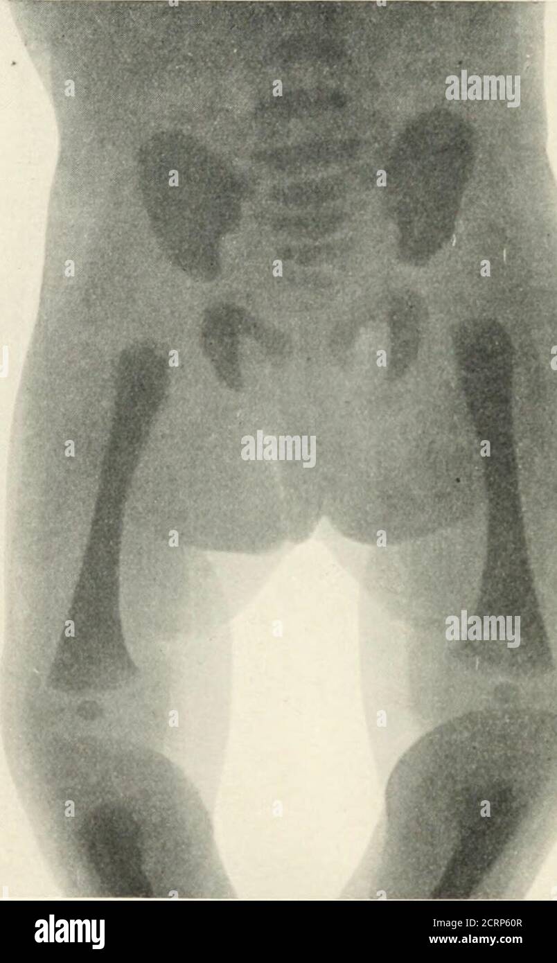. Radiografia, radioterapia e radioterapia . 118.--diagramma che mostra gli epiteli e le ossa che entrano nell'articolazione dell'anca. 148 R.iDIOGRAFIA l'osso e non fa parte del collo. In un'immagine a raggi X assomiglia in qualche modo all'aspetto dell'epijisi dell'estremità superiore dell'omero. I grandi e minori trocanteri derivano da centri separati di ossificazione, ma questi sono meno frequentemente visti nelle radiografie che non è l'epitisi dell'arger (vedere la piastra IX.a). Uppfir ond ofslitalt di epifisi femorale della testa della navata della testa appariva ancora epifisi per l'offemur dell'estremità inferiore Fig. 119.-Pelvi e femore di Foto Stock