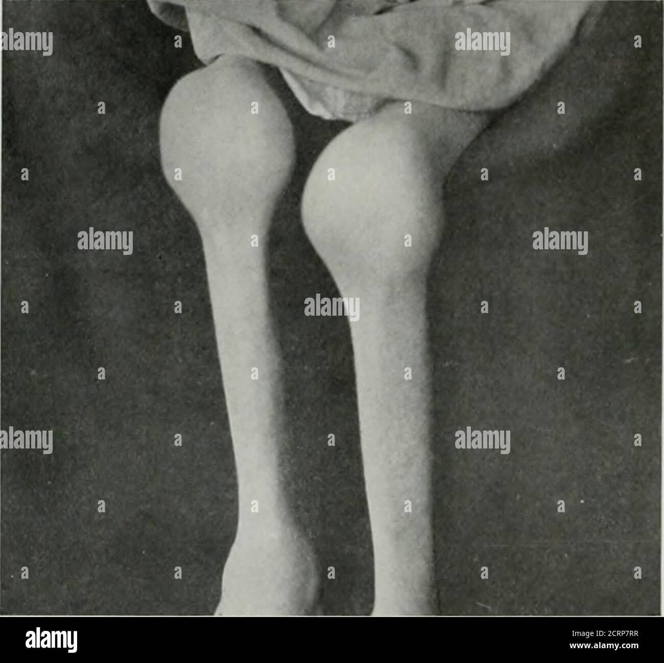 . Anatomia vivente e patologia; diagnosi di malattie nelle prime fasi della vita con il metodo Roentgen . COXDITIOX ATROFICO CRONICO DEL KNKK-JOIXTS. Ragazzo, 8 anni j-ears. Photoiiiiiiph del soggetto siinu n piastra 2M. Platk 2.r.i. PT.ATL. 2:51. UN IXII:(ARTRITE TIOUS DI TIIK KXEIC-JOIXT, SIIIOWTXC; A(TIROXIC ATROIIIR COXDITIOX. (Alcuni sulijcct come piastra 233.) (Dimensioni vita). 4. Punti a marcati ]icnrill((l contorno del femore dovuto ad uno corticale a densità di veridense. B. le superfici di articolazione irruvidite del femore, a causa di una certa erosione delle superfici di articolazione. C. punti alla zona di scarsamente sviluppato ])atella. Piastra Foto Stock
