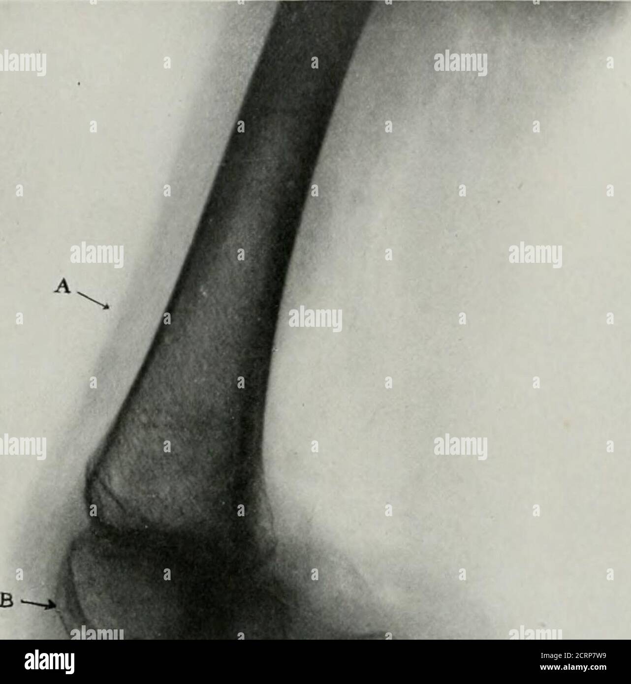 . Anatomia vivente e patologia; diagnosi di malattie nelle prime fasi della vita con il metodo Roentgen . PT.ATL. 2:51. UN IXII:(ARTRITE TIOUS DI TIIK KXEIC-JOIXT, SIIIOWTXC; A(TIROXIC ATROIIIR COXDITIOX. (Alcuni sulijcct come piastra 233.) (Dimensioni vita). 4. Punti a marcati ]icnrill((l contorno del femore dovuto ad uno corticale a densità di veridense. B. le superfici di articolazione irruvidite del femore, a causa di una certa erosione delle superfici di articolazione. C. punti alla zona di scarsamente sviluppato ])atella. Piastra 234. ^- * I Foto Stock