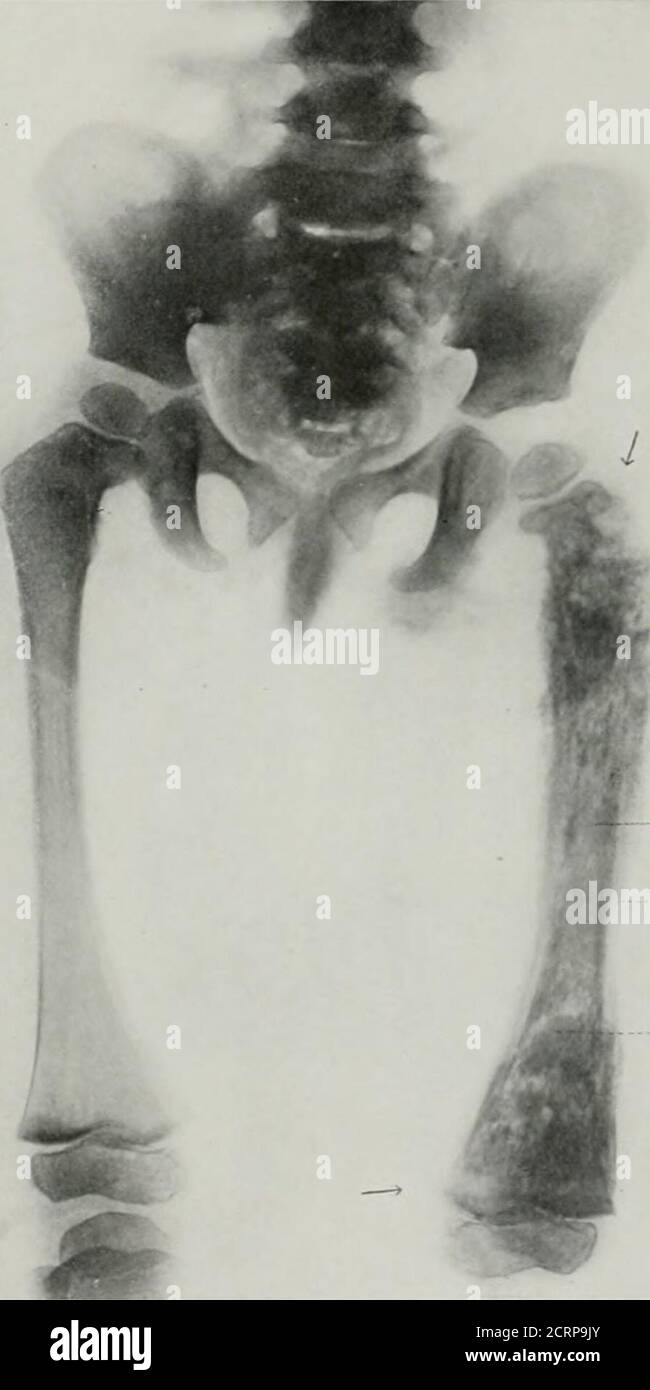 . Anatomia vivente e patologia; diagnosi di malattie nelle prime fasi della vita con il metodo Roentgen . PIASTRA 215. CHROXIC OSTEOJFiELITIS (distruzione iREAT DEL FEMORE). Età 21 anni?. (Stesso soggetto a.** piastra 214. Preso 5 settimane dopo.) 1. Un'area di suppurazione. 2. Nuovo formod ])osso oriostcal. 3. Osso corticale necrotico. Le frecce mostrano i punti di attacco della capsula eperiosteo. Il gambo del femore, l'anca e le articolazioni del ginocchio non sono coinvolti; l'infezione è confinata all'interno di dellimit del periosteo. Lati: 21.5. PIASTRA 216.OSTEOMVELITIS DEL GOMITO. Ragazzo, 9 anni. (Dimensioni vita). Mostra Foto Stock