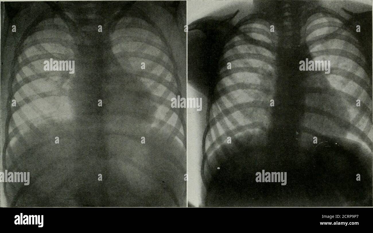 . La rivista americana di roentgoenologia, radioterapia e medicina nucleare . is sono solo sviluppi secondari di un'infezione della radice primaria, è di- vente che le platee postero-antero ordinarie del torace non possono avere un adeguato valore diagnostico per la tubercolosi, poiché i visiblechanes in questa condizione ad un'estensione grande per un certo tempo avvengono nei nodi che circondano la trachea e la prima porzione dei bronchi, E queste strutture sono ob-scured dal cuore e grandi ombre vaso.abbiamo avuto recentemente l'opportunità di controllare i risultati fisici e radiografici, ed è stato obse Foto Stock