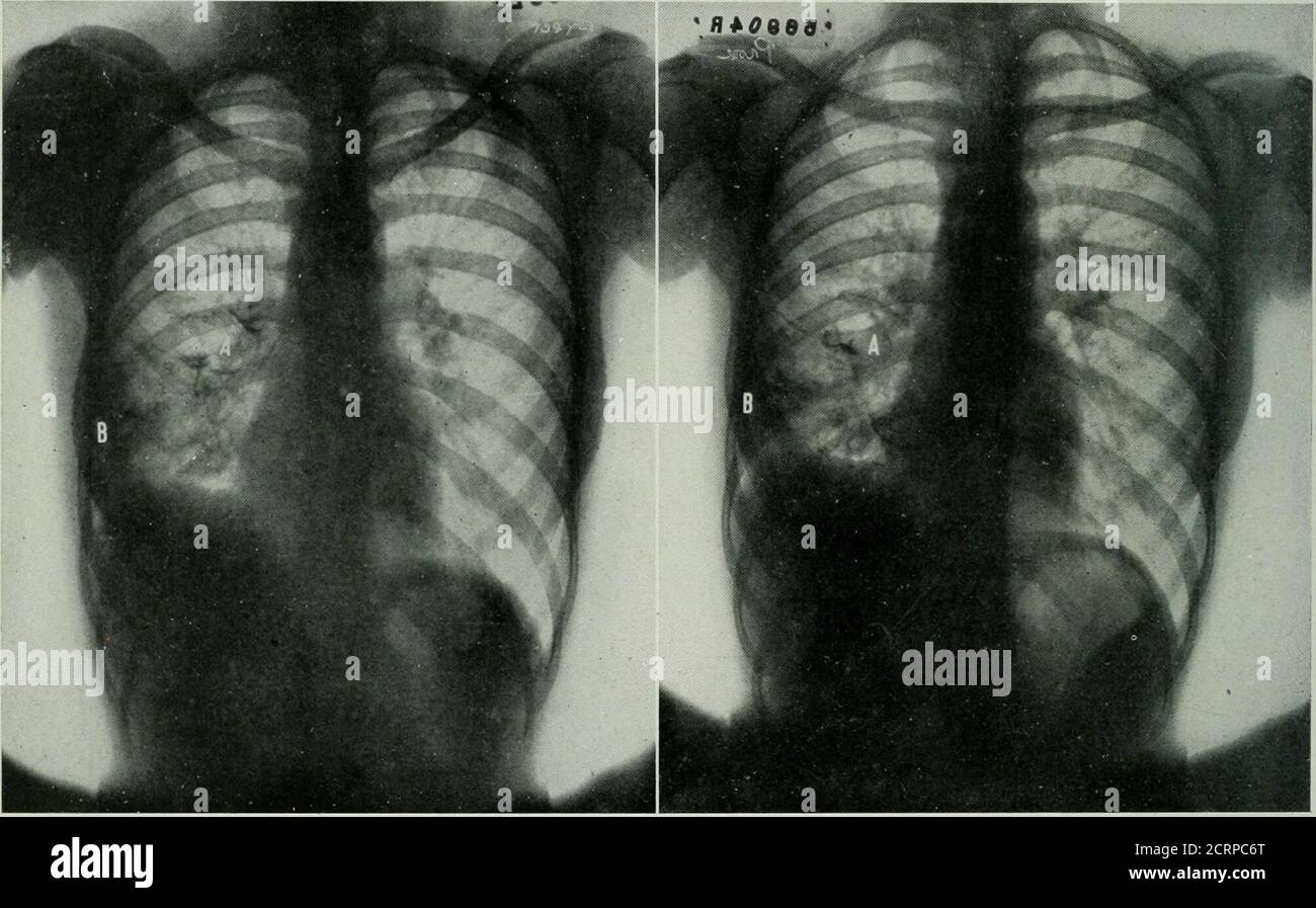 . La rivista americana di roentgoenologia, radioterapia e medicina nucleare . ood. Là vagano e soritino nella parte inferiore del thechest. È stata operata nel maggio 1919. RIB re- 56 Studi Roentgenografici di Bronchiectasis e sezione di ascesso polmonare è stato eseguito e la cavità Dakin-ized; nessun ascesso è stato trovato. Il seguente settembre l'incisione è stata riaperta e il tubo posto nella cavità; non c'è stato alcun drenaggio-età; si è verificato un miglioramento molto scarso. Nel novembre 1919, una nuova incisione fu madelower con resezione di una costola; un tubewas lasciato nella cavità, ma nessun drenaggio oc-curred. A Januar Foto Stock