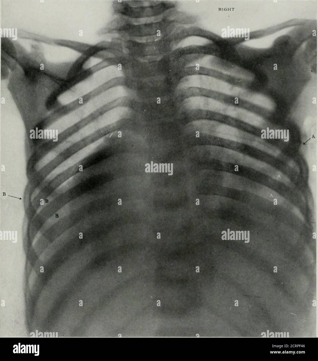 . Anatomia vivente e patologia; diagnosi di malattie nelle prime fasi della vita con il metodo Roentgen . I >■ ■«■■,■ f-i^- ,^-.-;-njtm-:x^-. PIASTRA li:?.LOBAR l.eu.K)ma. OhiH, 10 anni. (Ridotto 427c..) 4. Solidificazione del lobo inferiore ri^i^ht con un'area sliIII;lessscniod oonsoliilation appena sopra di esso. Owini; a tlie lackof movement in the lunf^, ]jrodotto Ijy la sua solidificazione,i bronchi della lol superiore)es, specialmente a destra,sono diventati c|uite distinti. B. consolidamento del lobo inferiore sinistro. Platk II;3. Il.AII; 111. UXRESOLVED LOBAR INIAMdXIA. Cjirl, età 4 anni. (Reiuced 3 Foto Stock