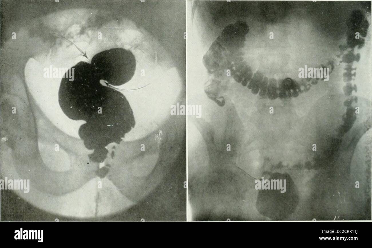 . La rivista americana di roentgoenologia, radioterapia e medicina nucleare . Fig. ii insufflazione di subcarbonato di bismuto in uscita da un apparecchio rettosigmoide definitivamente contratto. Notail contorno del retto che è parzialmente gas-tilled. Fig. 12. Enema di bario che mostra il contorno del rettumee una porzione del colon pelvico. La parte di collegamento stretta è l'apparecchio rettosigmoide. Patienthad ascesso pelvico molti anni fa: L'essudato risultante ha fissato il retto ed il colon in questa posizione. Fig. 15. Normale apparecchio rettosigmoide nella fase Icontrattura parziale. Verificato mediante sigmoidoscopia. FLG. [4. & Foto Stock