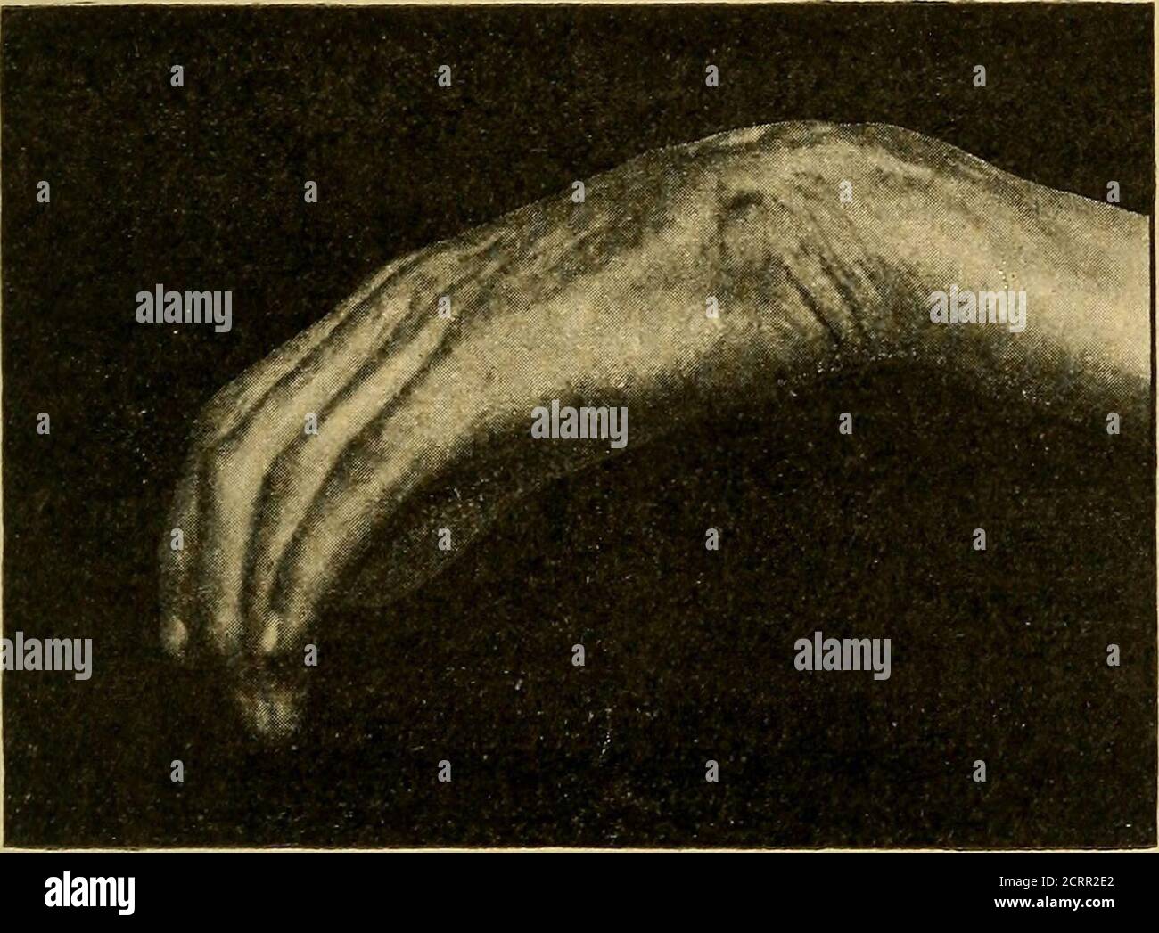 . Erbringung und Erbringung von Unfallheilkunde sowie der Nachkrankheiten der Unfallverletzungen : mit 40 fargigen Tafeln, nach originalquarellen des malers Johann Fink und 141 schwarzen Abbondungen . Fig. 40.. Fig. Narben auf dem Handgelenk. Narben, welche die Bewegungsfähigkeit des hand-gelenks beschränken, haben oft eine Erwerbsverminderungzur Forge. JE weiter die Narben über das Handgelenk 344 hinaus nach dem Handrücken oder über die Hohlhand zuden Fingern reichen, desto grösser ist meist die Funktions-störung. So können bei einem sonst tadellosen hand-gelenk Keloidnarben, die sich über das hand Foto Stock