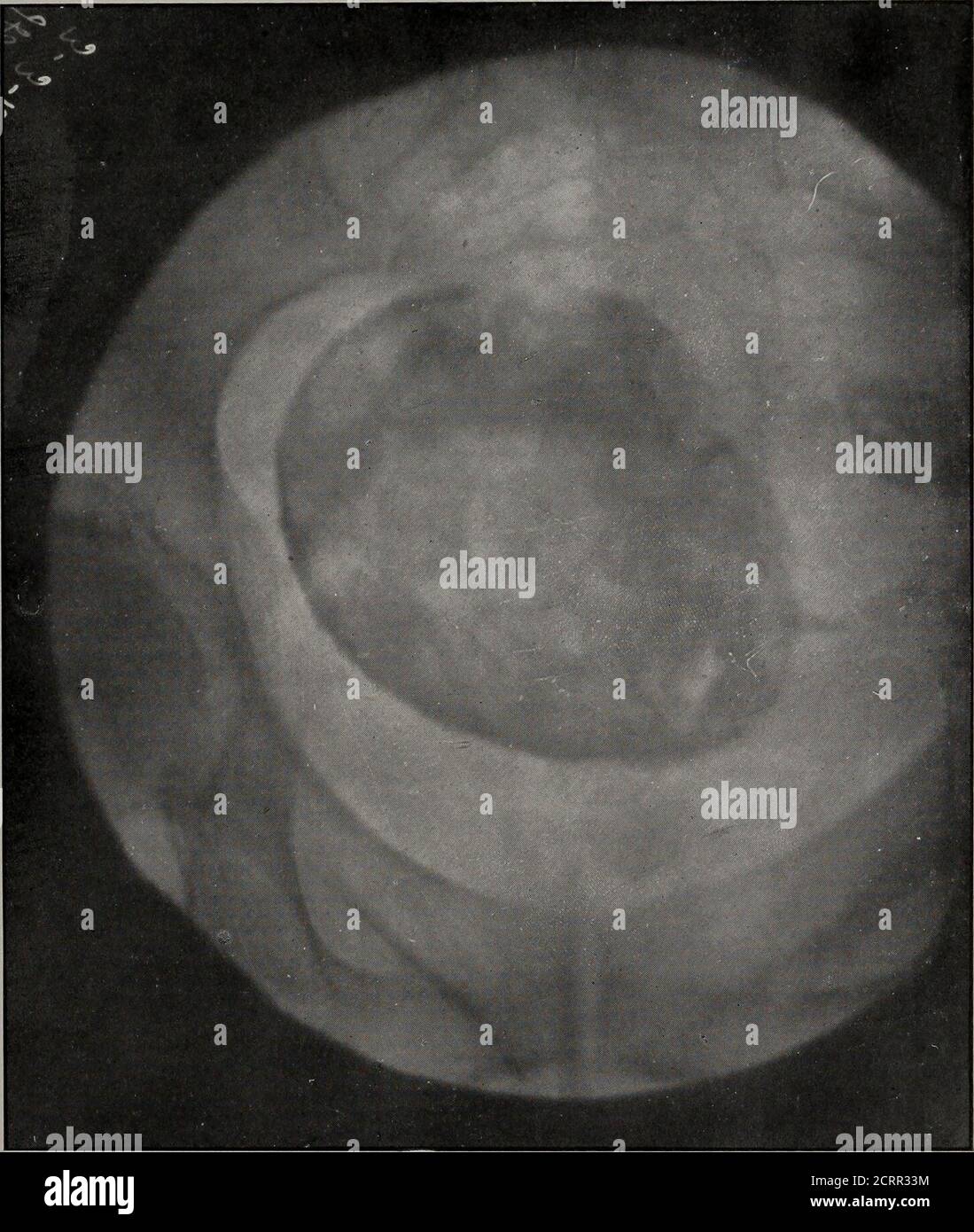 . Trimestrale americano di roentgoenology . gh tavola con tetto di tela con palle-bearingfeet. Per attivare e disattivare la corrente durante l'esame fluoroscopico, ho bisogno di assistenza, mentre la radiografia che attendo personalmente, soprattutto per motivi di protezione, è schermata in sala miopiombo. Guardare il fluoroscopio durante la radiografia è arduo e oltre a inutile procedura. In conclusione, posso affermare che la mia dimostrazione ha mostrato un apparato atechnicamente corretto e pratico per la combiningfluoroscopia con radiografia nella diagnosi addominale con la massima sicurezza possibile nell'esecuzione di qualsiasi wor fluoroscopico Foto Stock