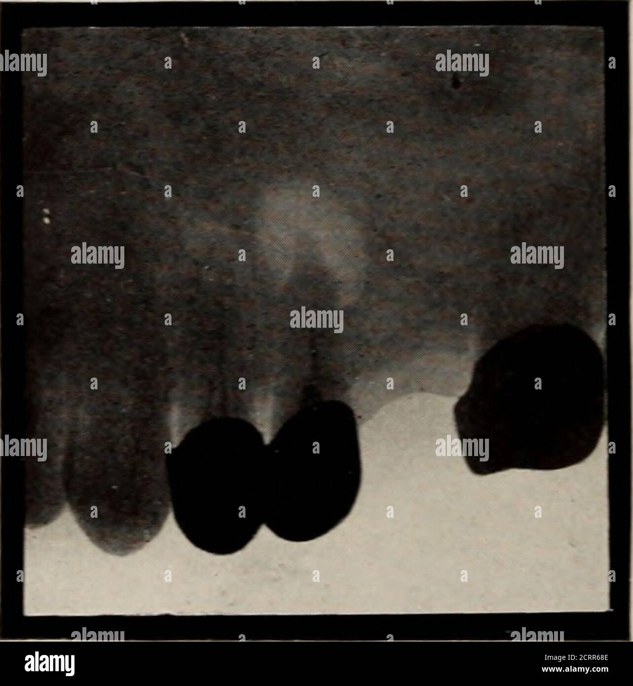 . Radiografia dentale e orale : un libro di testo per studenti e professionisti dell'odontoiatria . Fig. 59. Tra gli incisori centrali e laterali è visibile un ascesso. Il suo origincould essere dovuto sia al dente che forse ad entrambi. Fig. 60. Vi è evidenza di un piccolo ascesso alveolare intorno all'apice del rootdel primo bicuspide, mentre uno più grande è dimostrato esistere intorno alla radice del secondo bicuspide; senza spostamento sono spesso percepibili in corrispondenza della linea di frattura, Grazie al fatto che la linea DI INTERPRETAZIONE DELLE fratture RADIOGRAFICHE 137 offre una minore resistenza alla penetrazione dei raggi Foto Stock