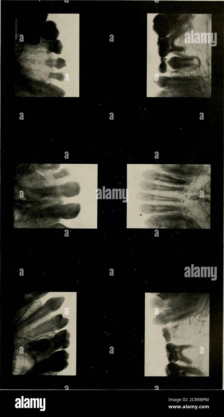 . Radiografia elementare e dentale. L'eduzione negli ascessi alveolari è una questione di cui sappiamo completamente troppo poco. Uno studio radiografico sistematico del soggetto è destinato a risultare nella divulgazione di fatti interessanti e im-portant. Una domanda, la cui risposta è di extremeTigs. 300 e 301. Importanza è, le cavità di ascesso alveolare sono state riempite di osso dopo che l'ascesso è guarito? La mia ex-perenza mi porta a credere che lo fanno; ma il nuovo osso non è così denso, ed è suscettibile alla pronta disintegrazione come risultato di contigua in-flammation. Per chiarire: Osservare la Fig. 300, un cas Foto Stock