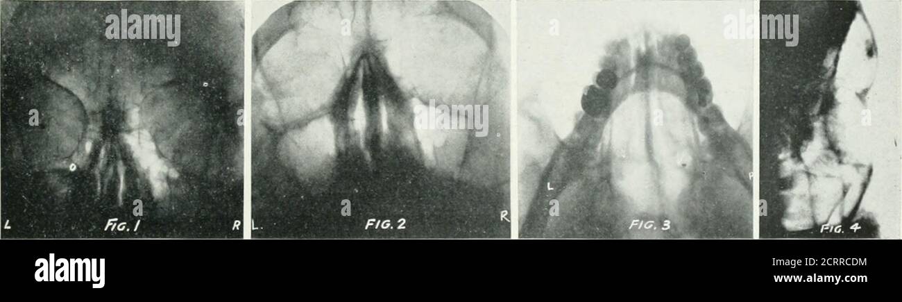 . Archivi di medicina fisica e riabilitazione. F il piano del tavolo. La testa deve avere un allineamento normale inesatto con l'asse longitudinale della colonna vertebrale, e una linemusta verticale deve tagliare i centri delle pupille di botheyes. La punta del naso e la protuberanza occupanti ex-eterna devono essere equidistanti dalla superficie del filmholder. L'asse centrale dei raggi X è orientato verticalmente verso il basso, al centrosul processo angolare esterno. Thisview è di massimo valore in certi casesin cui l'assenza di cellule frontali è differenziata dai seni riempiti di pus.se l'osso frontale non si divide intoan Foto Stock