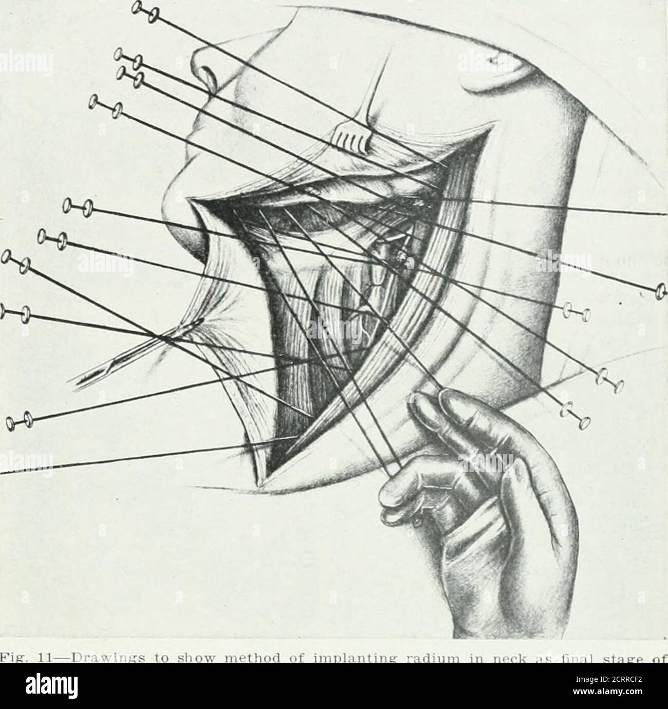 . Archivi di medicina fisica e di riabilitazione. Condotti attraverso le superfici di ul-cerating fallo - sotto tali posizioni circensi attenzione dovrebbe essere presa per intro-duce attraverso i tessuti salutari circostanti e diretto verso la base tumorale. I pericoli di danni ai vasi nervosi e sanguigni e di creare un effetto caustico locale toomuch non sono seriousand sono questioni prontamente evitate da ex-perienza. Allo scopo di confrontare, dal punto di vista fisico, l'efficienza dei tubi scoperti, all'interno del loro campo, con metodi di radiazione esterna, ho haveconstructed un certo numero di dia-grammi pratici, dando in ogni istante Foto Stock