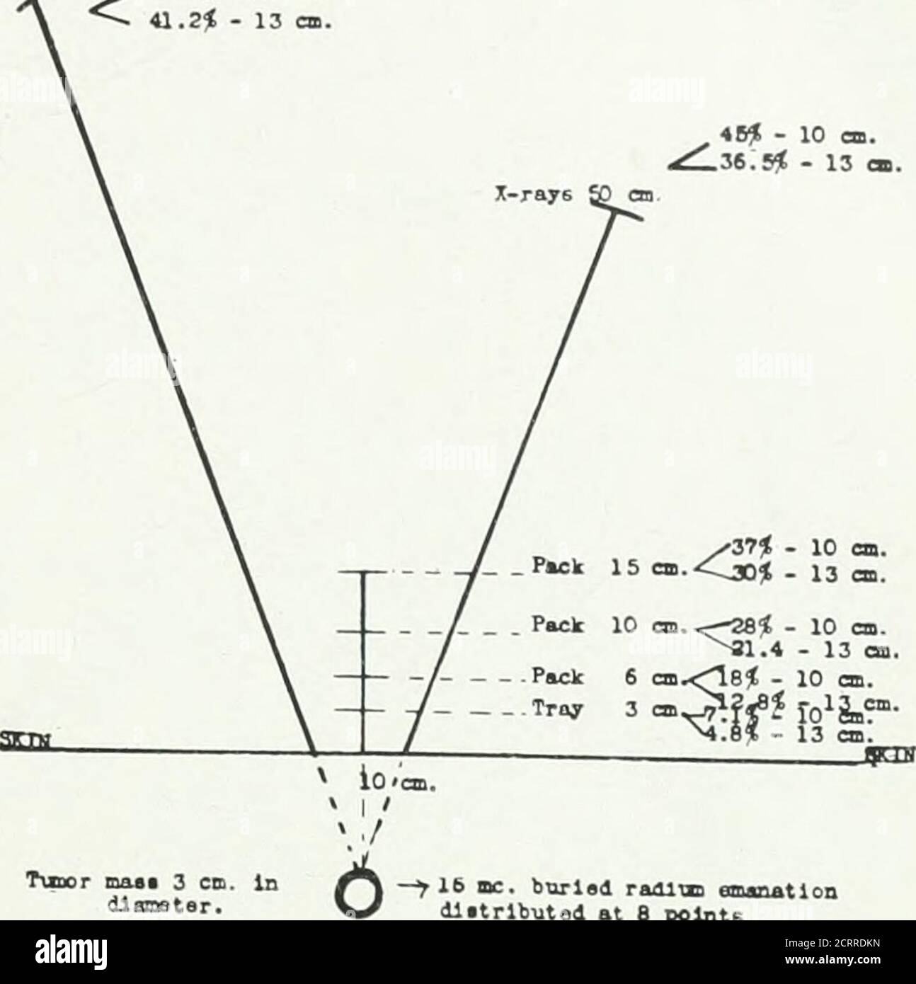 . Archivi di medicina fisica e riabilitazione . 3;an. Pack È un. (UctBnca&lt;71^ - 3^se* 6 Pack 10 cn.&lt;^4&lt; - 3 Pack 6».&lt;^|-| tra. 3^.^^1^^.3g,^  ^^ Tumor maas ^.., IJ -^16 mc. Anat sbavato•»/ ^ punti B in Ion distributedpolntt 634^ a perVuharr.Pig. 3 Fig. --j.;iji:nel mostrare il valore relativo di Iadiuiemanazione buritd, radium filtrato esternamente e raggi x ad alta tensione. Le percentuali sono in termini di dose di eritema alla superficie cutanea^•ken a.^ 100. Dose di emanazione radiosa UNF^ltered calcolo solo per raggi-y. Sadlnm fnctora: Filtro, 2 mm. Passante in ottone; confezione da 15 cm. ^-= 42, Foto Stock