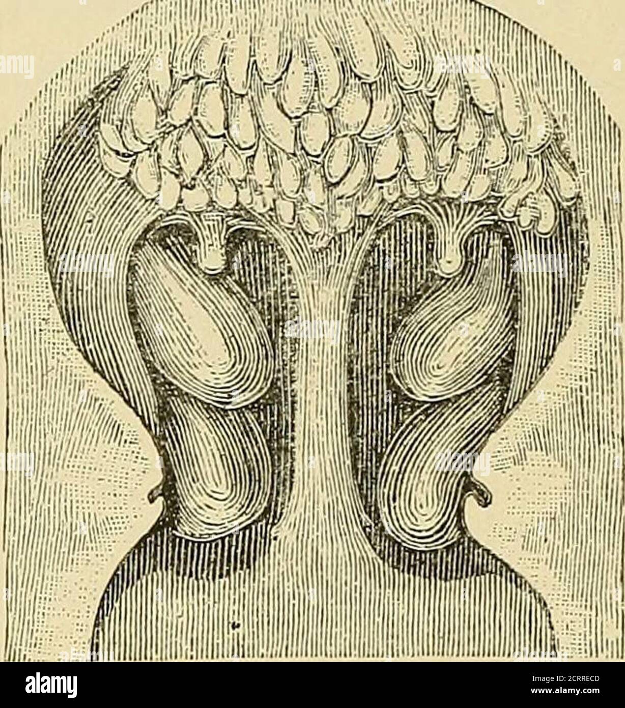 . Malattie del naso e della gola. Senza bisogno di migliorare l'orcura, mentre richiede, ed è ugualmente amabile, una linea di trattamento simile - una guarigione rapida o positiva essendo impossibile, mentre miglioramento dei sintomi e un buon grado di comfort può sempre essere ottenuto. Quando la malattia di Tornwaldts o l'infiammazione della cosiddetta bursa farina-geal, l'incisione libera, con successivo trattamento antisettico, sarà spesso seguita da un buon risultato. CAPITOLO XXXVIII. CRESCITE ADENOIDI DELLA NASOFARINGE. Gli adenoidi post-faringei sono ipercrescenze o divorazioni anomale dei tessuti linfoidi che esistono Foto Stock
