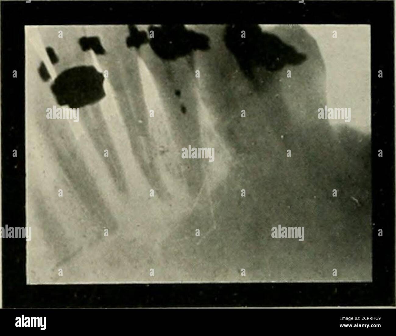 . Radiografia elementare e dentale . Fig. 201 Fig. 201 Fig. 200. Ascesso che coinvolge gli incisori superiori centrali e laterali. C'era solo una fiistulousopening sulla labiale. Poiché i canali di centrale e laterale sono entrambi opportunamente riempiti, il trattamento dovrebbe consistere semplicemente in una curettizzazione della zona interessata, che, ovviamente, non richiede la rimozione delle corone post-porcellane dai denti. (Radiografia di risma, di Chicago.) Fig. 201. Il Dr. Rhein dice di Fig. 201: Si tratta di un caso tipico di ascesso alveolare cronico, che per anni era stato erroneamente trattato per la piorrea. Foto Stock