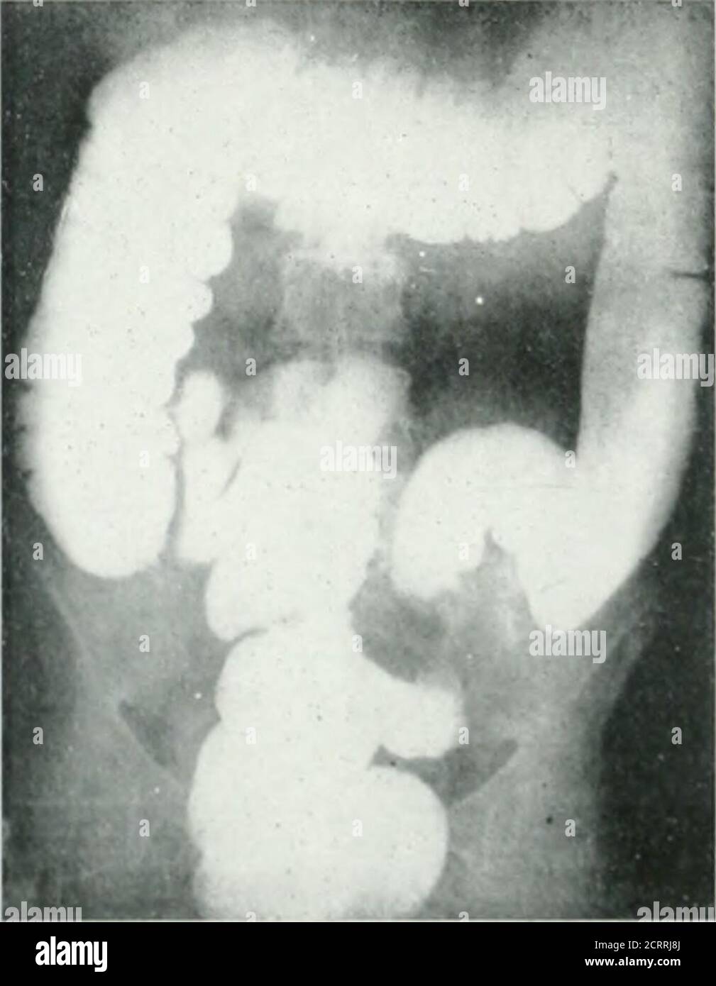 . Archivi di medicina fisica e riabilitazione. Wasdubtful e ha riferito il caso come in-determinate. Nonostante la fortunata dimostrazione, è facile da sotto-stand che i cancri non-ostruttivi di queste flessure possono essere trascurati, essere-causa dei vari contourand normali la fusione degli angoli. Dei 54 cancri ad anello, solo un avviso onewaded per mezzo del roentgenray, e ovviamente questa forma di cancershould essere più facile di tutti da trovare. Ma la possibilità di esame non è al-way dato; durante il periodo coperto da questo studio 30 casi supplementari di cancro anulare sono stati inviati a operati Foto Stock