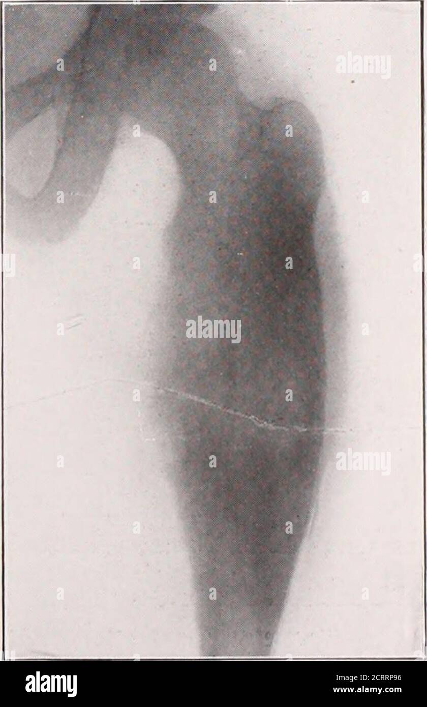 . Giornale di radiologia . Fig. 70. Percorso. N. 23284 (IX). Pareoma perioteale con eccessiva boneformazione, che suggerisce ossifyingmiosite. Vedere le pagine 193 e 199. Fig. 72. Percorso. N. 15745 (IX). Sarcoma perioteale dell'estremità superiore di fe-mur, simile all'osteomielite.sec pagina 200. 232 IL JOURNAL OF RADIOLOGY Foto Stock