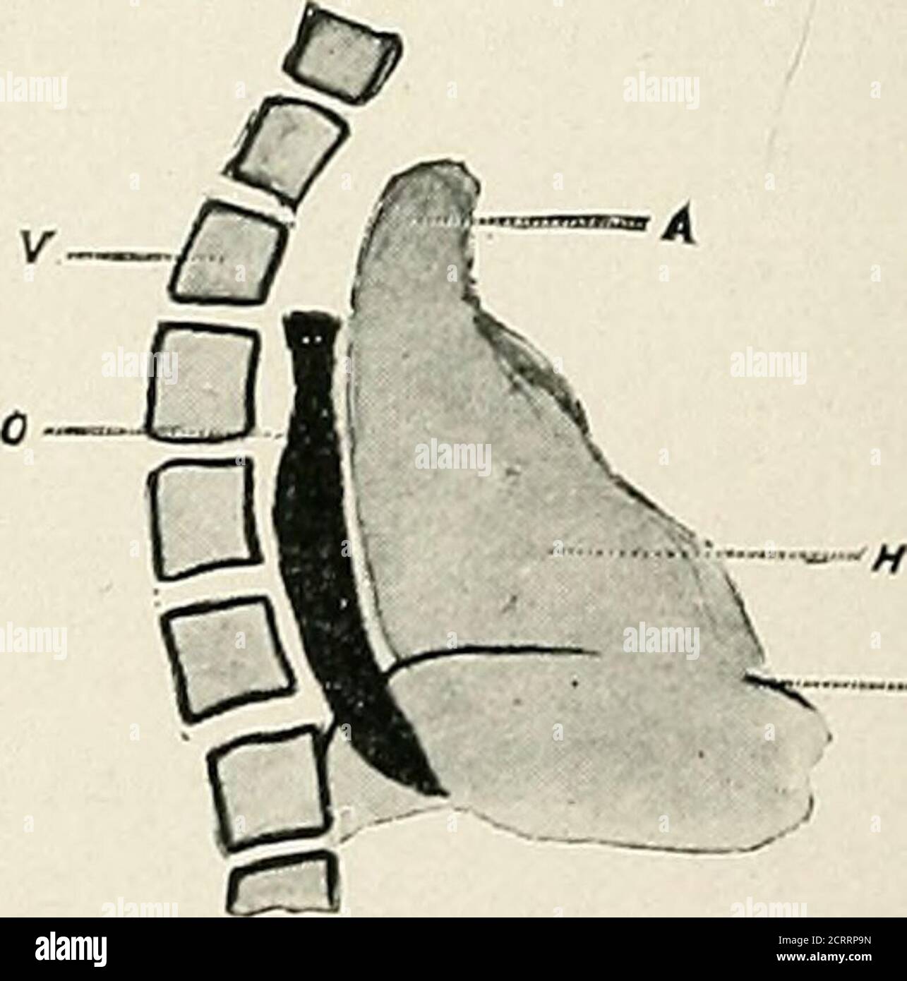 . Lo stomaco e il sofago : uno studio radiografico . Fig. 6. Fig. 1. Rappresentazione diagonale della vista semi-laterale del posteriormediastino con il normale decorso dell'esofago indicato dalla linea tratteggiata. (A.. Aorta. H. cuore. JJ. Diaframma. Esofago O. V. colonna verticale. Fig. 2. Lieve dilatazione dell'arco aortico con ritardo del bismuto sopra di esso.Nessuna ostruzione reale. Fig. 3. Grande aneurismo dell'arco aortico con ostruzione esofagea. Fig. 4. Crescita nel mediastino posteriore che circonda e ostruisce l'esofago. Fig. 5 e 6 rappresentano un'ostruzione dietro l'arco aortico e. Foto Stock
