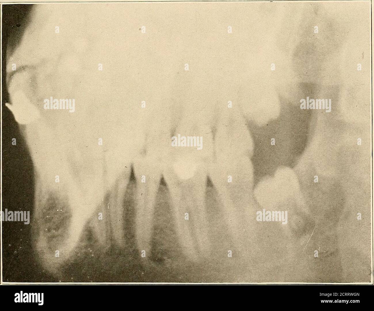 Radiografia dentale e orale : un libro di testo per gli studenti e i  professionisti dell'odontoiatria . Fig. 95-^4.. Fig. 95-5.Fig.  95.-radiogrammi Fxtra-orali di terzo molari impattato e remunerato. 150  RADIOGRAFIA