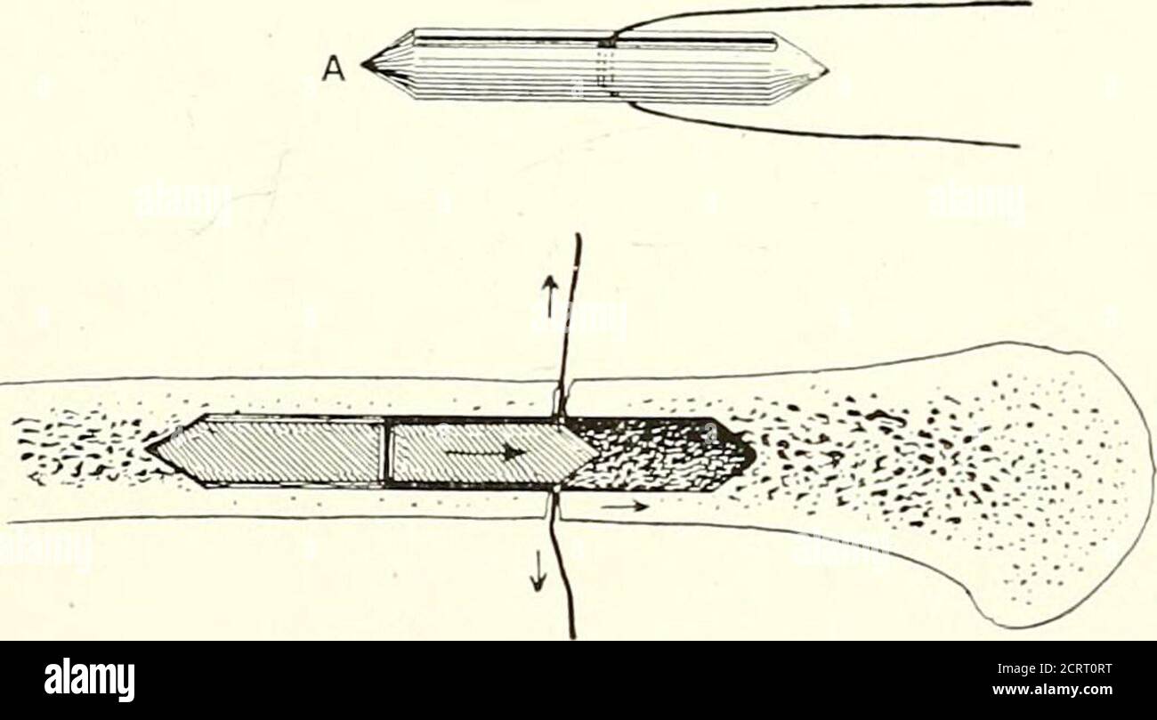 . Sui moderni metodi di trattamento delle fratture . TRATTAMENTO OPERATIVO DELLE FRATTURE 191 al centro, e una scanalatura lungo ciascun lato, per prendere il filo di trac-tion. Dopo che la frattura è stata esposta, ciascuna estremità è portata all'esterno della ferita a sua volta, e forata da una punta elicoidale di tale dimensione che la spina scorrerà facilmente nella sua cavità. Una sfilacciatura deve essere alesata abbastanza lontano da prendere l'intero piolo, l'altra necessità di ospitarlo solo per metà della sua lunghezza. Quando questo è stato fatto, il frammento alesato ha il bordo interno affilato smussato per mezzo di un alesatore conico, per consentire al filo di trazione di Foto Stock