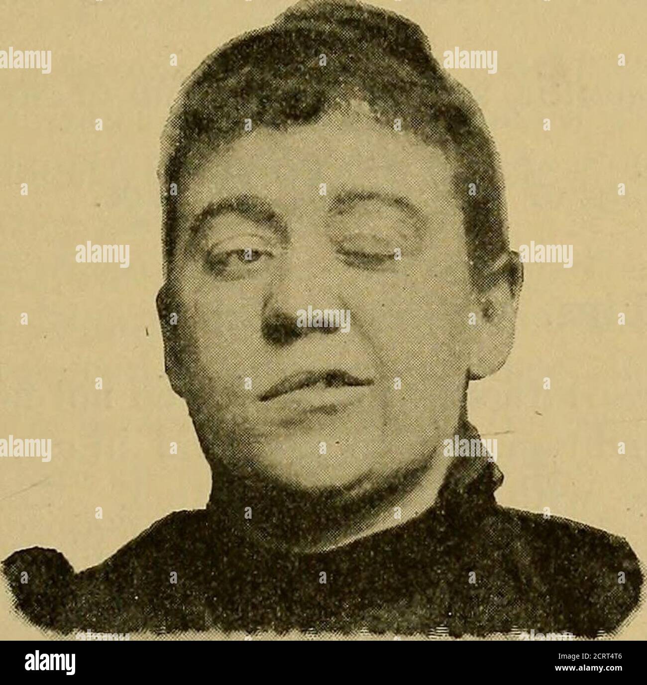 . Un trattato pratico sulla diagnosi medica per studenti e medici . f articolazione, e dribbling della saliva. A volte il paziente è in grado di aprire le labbra, ma non può closetele senza l'aiuto delle dita. L'espressione di immolabilità simile a maschera in agitatori paralisi è stata descritta come maschera di Parkinson. Un modo lento, esitante, denso di parlare, con una tendenza a slurthe labiale e consonanti linguali, quando associato ad irregolarità degli alunni, leggero tremore delle labbra e perdita del regolamentofine di altri movimenti muscolari, come la scrittura, è molto suggestivo o Foto Stock