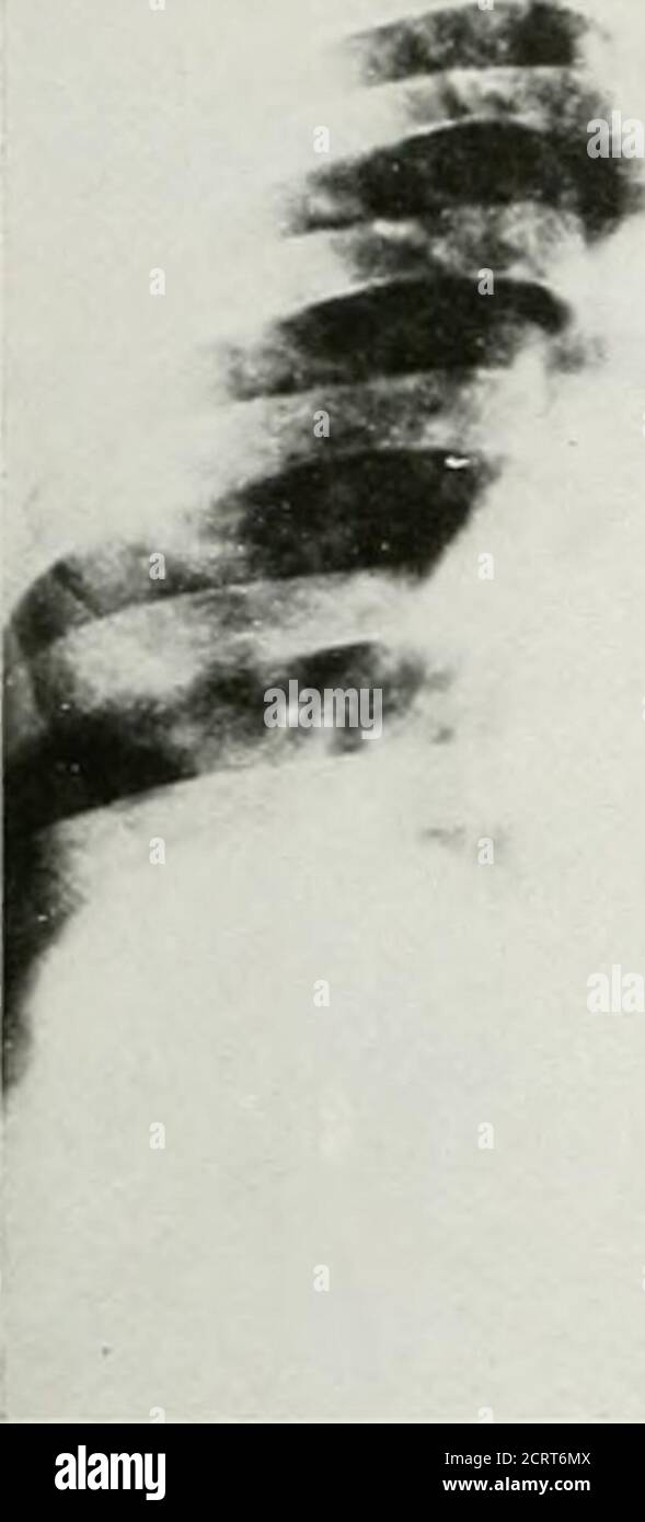 . La rivista americana di roentgoenologia, radioterapia e medicina nucleare . Causa 512/85. Secondo esame. Causa 512/85. Terzo esame. Influenza e bronchopneumonia 233 periferia e gradualmente meno verso il thehilus. In due di questi casi la diagnosi della broncopolmonite è stata fatta solo dopo la risoluzione era iniziata. Nei rimanenti cambiamenti del parenchima e prima che le zone piccole di densità diventino confluentee la congestione così grande da simulare la polmonite lobare. Foto Stock