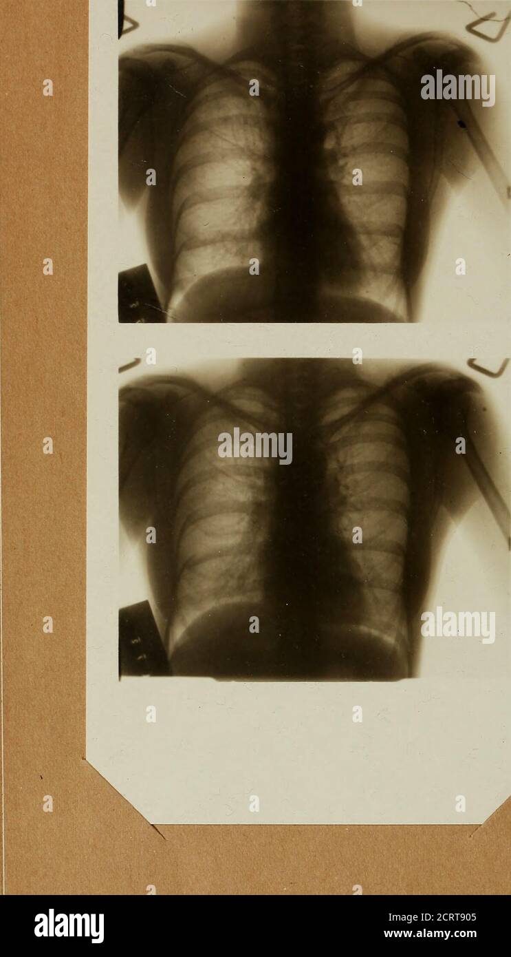. Trimestrale americano della roentgoenologia . 60 C ■£<£6c * o U £ C <8- •£ a CC o 13 « v 2 ** S-° . 2 « fiJ2© .S o. C ps 2-3 £S 5.2 -si - o- L  C *J• 3 eo jCT3° c v «.£ 09 4-* 3 a rs o «J- 6090 u. O Z e DQ i-0) u io < -ID o Dunham : Piastre stereo-toraciche 119 divisioni che corrispondono approssimativamente ai lobi del polmone. Nelle iniezioni di bismuto dei bronchi queste corrispondono veridimamente ai lobi, e in alcuni casi le thesedivisions della malattia sono quasi chiaramente marcate come nelle iniezioni. Così sul lato destro abbiamo il hylus, il trunksand pesante tre divisioni principali, una superiore, metà Foto Stock