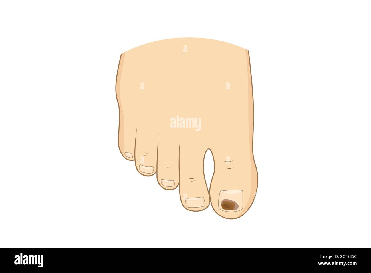 Illustrazione vettoriale della micosi marrone a coda di rospo. Unghie di punta salute, sentire fungo, cura del corpo Illustrazione Vettoriale