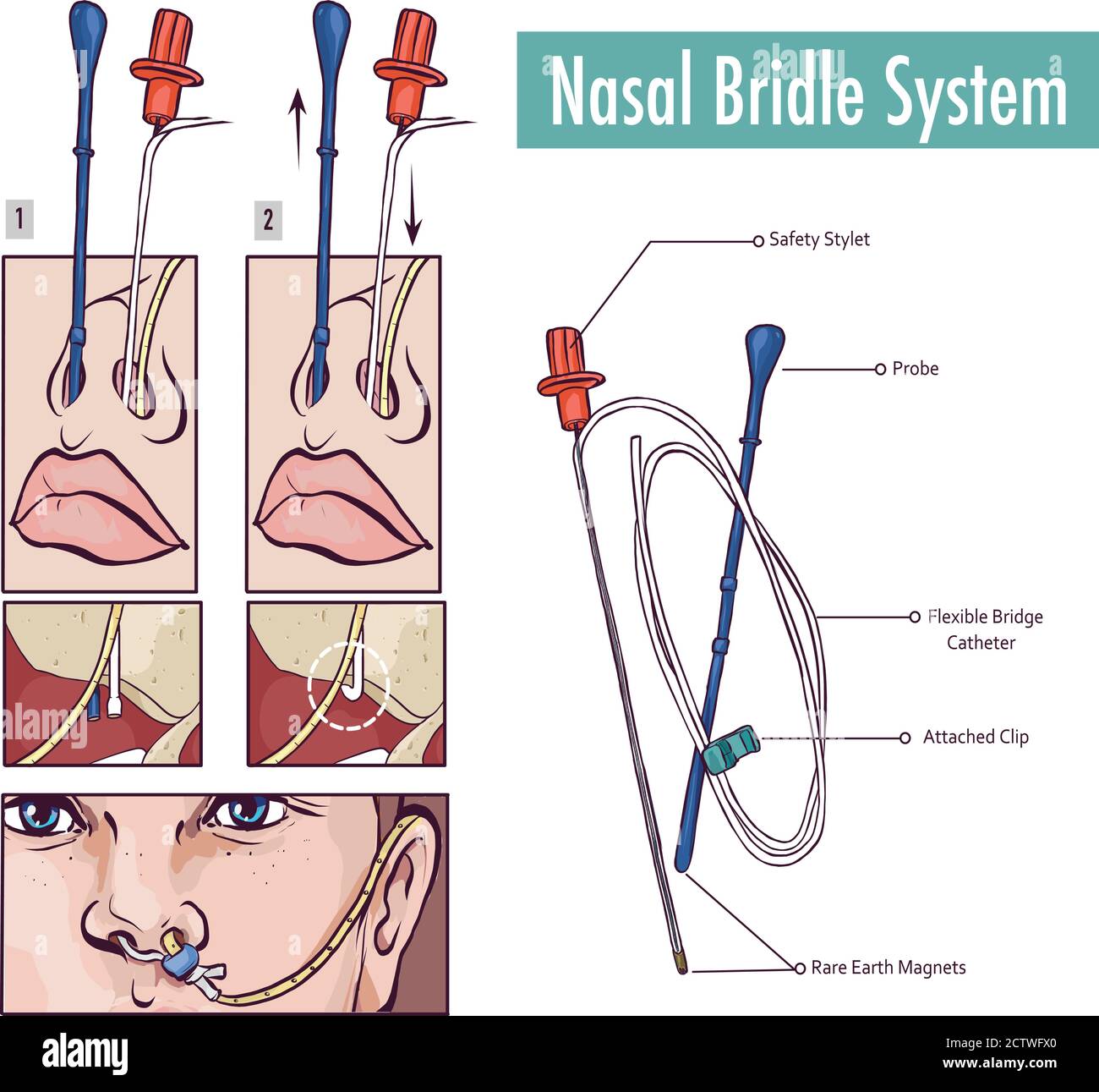 Una briglia nasale che fissa un tubo nasogastrico al nasale setto per evitare l'estrazione accidentale Illustrazione Vettoriale