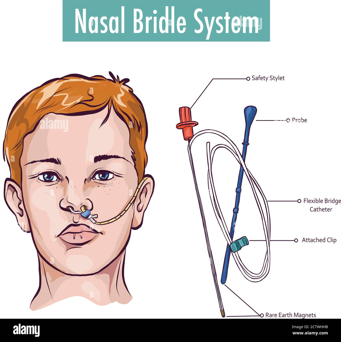 Una briglia nasale che fissa un tubo nasogastrico al nasale setto per evitare l'estrazione accidentale Illustrazione Vettoriale